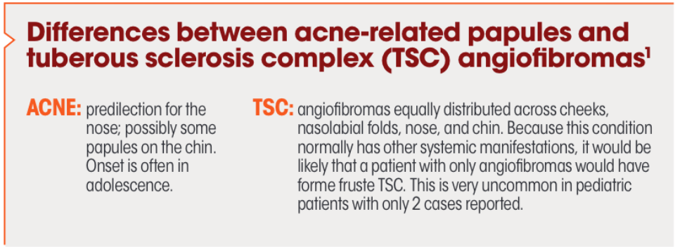 Differences between acne-related papules and tuberous sclerosis complex (TSC) angiofibromas.