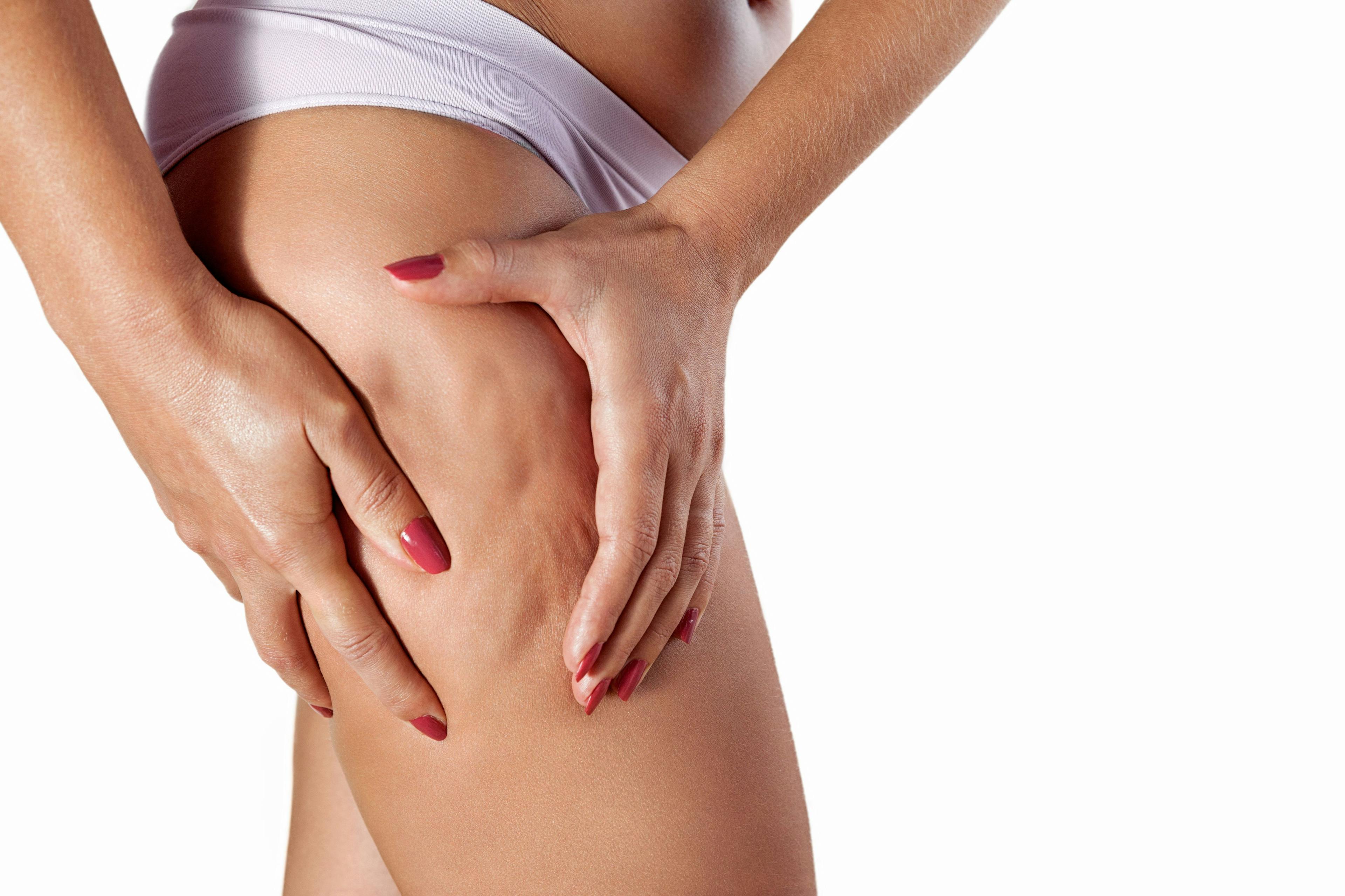 The Reality of Cellulite Treatments in 2023 