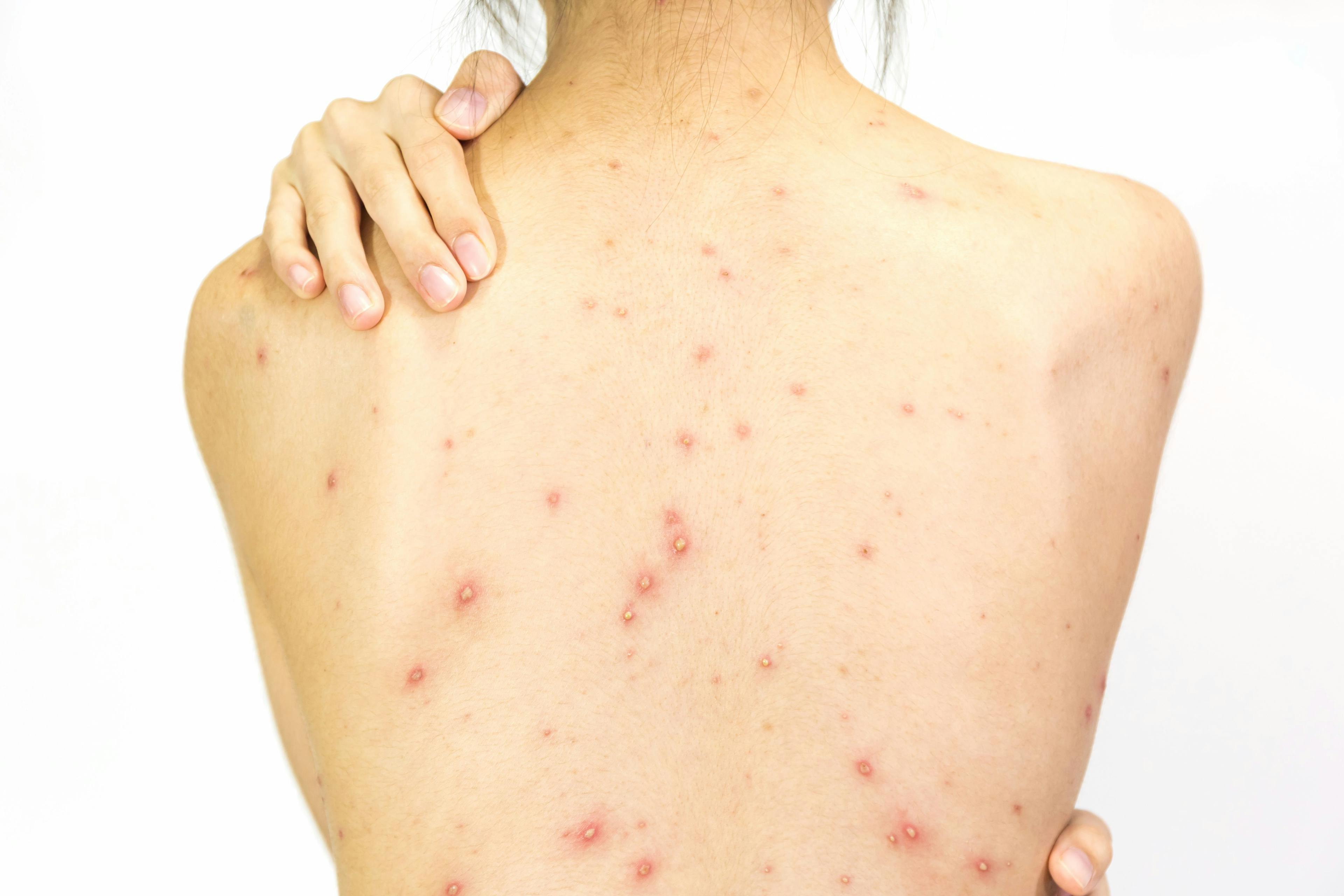 All You Need to Know About Back Acne