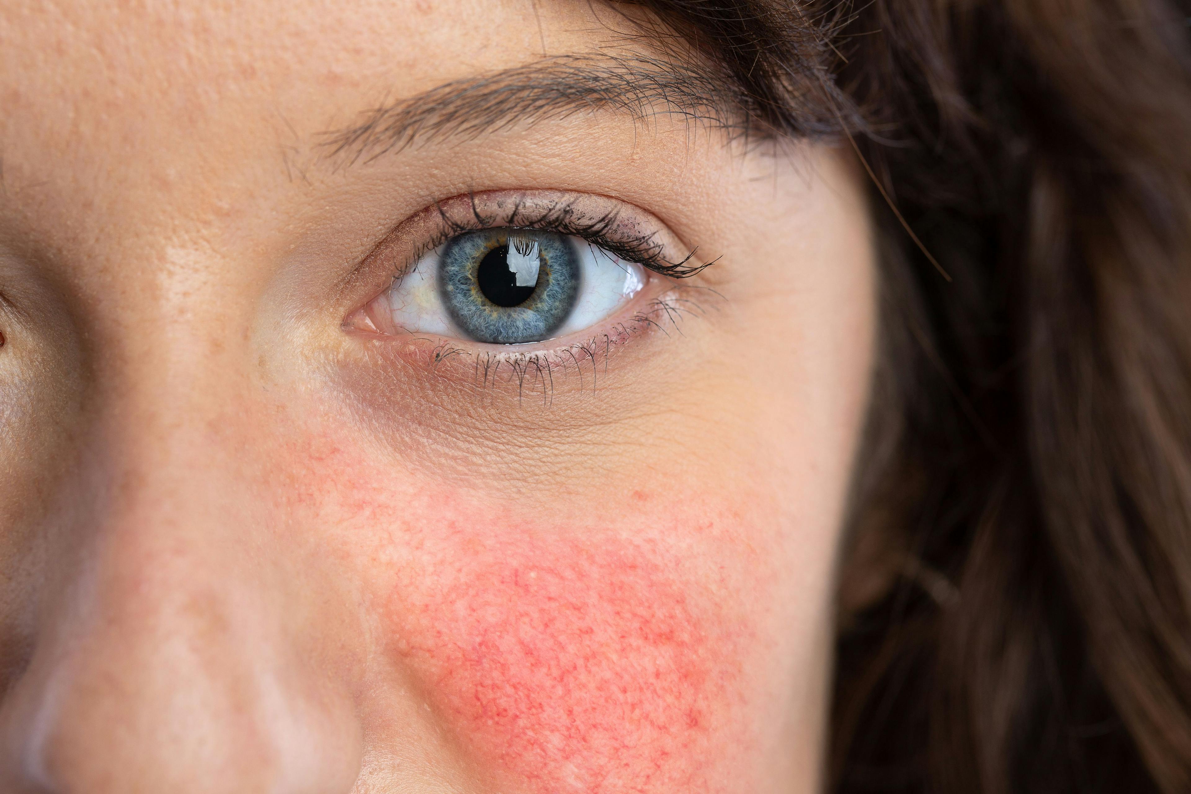 Using Combination Therapies and Avoiding Subtypes for Rosacea