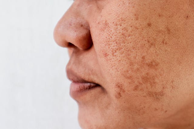 Microneedling Combined With Glutathione Promising in Treatment of Melasma