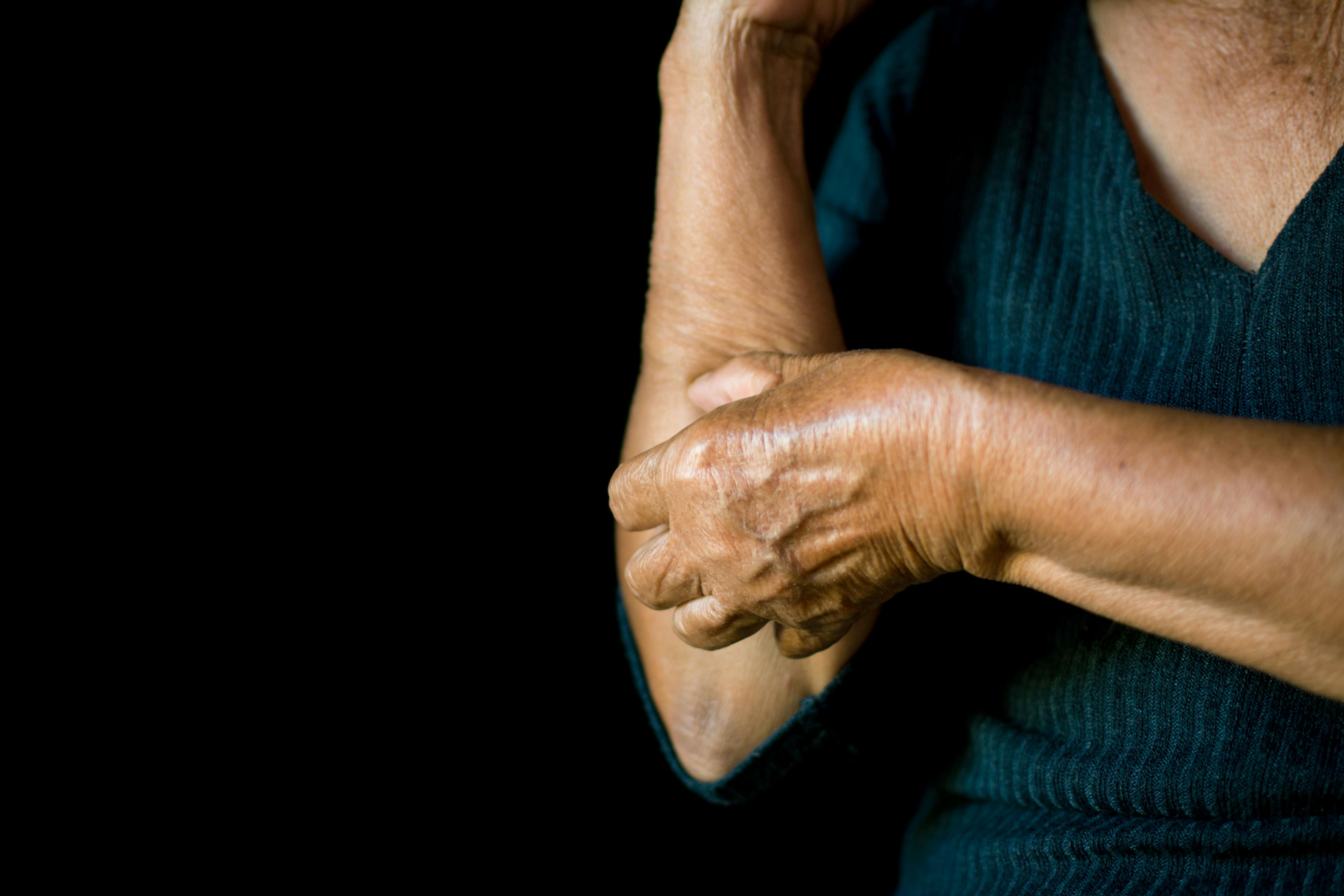 No Differences in Severity or Treatment Among Racially Diverse Eczema Patients