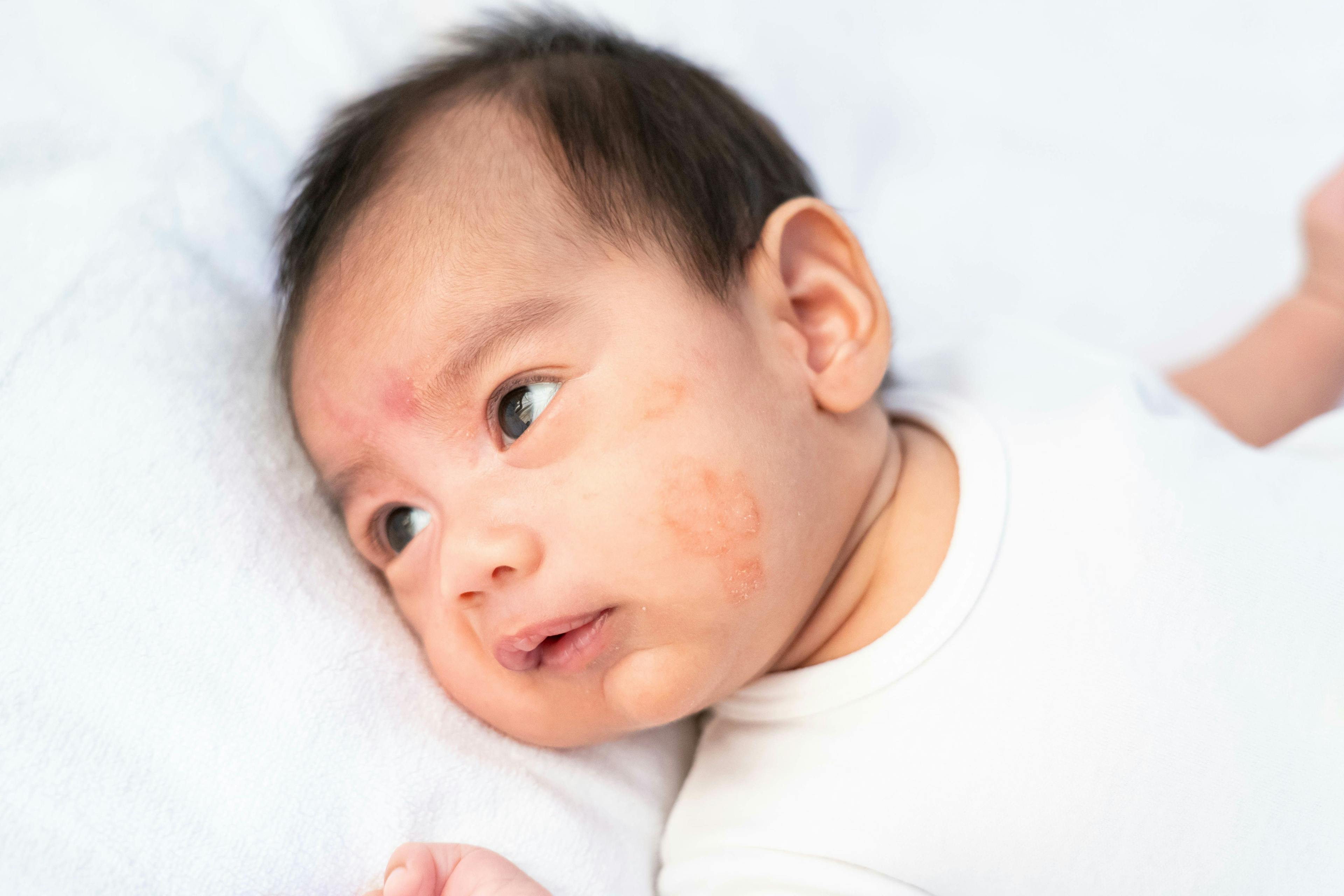 Eczema Associated With Heightened Risk of Peanut Allergy in Infants