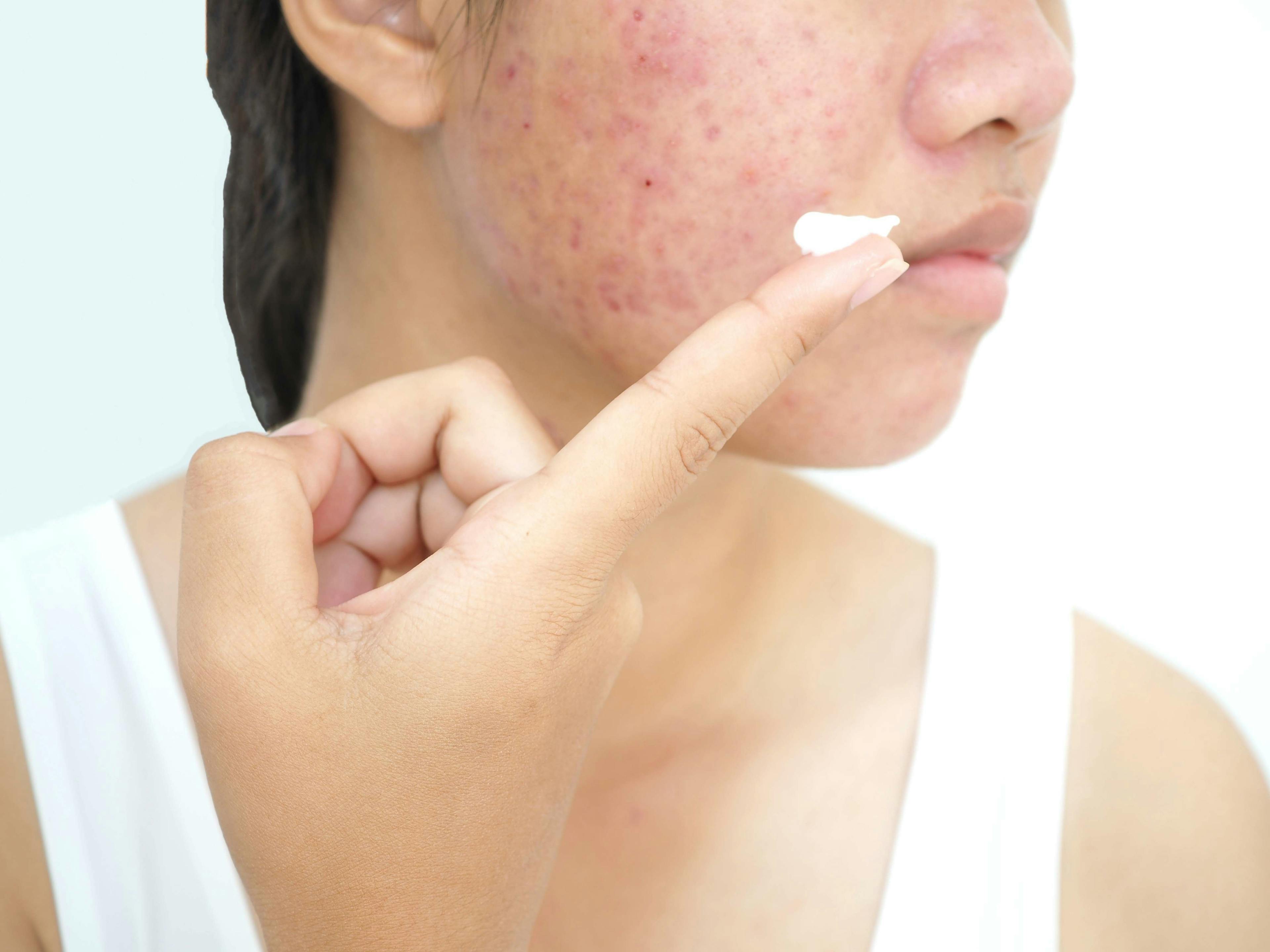 Acne, Skin Appearance Improved With Salicylic and Lipohydroxy Acids