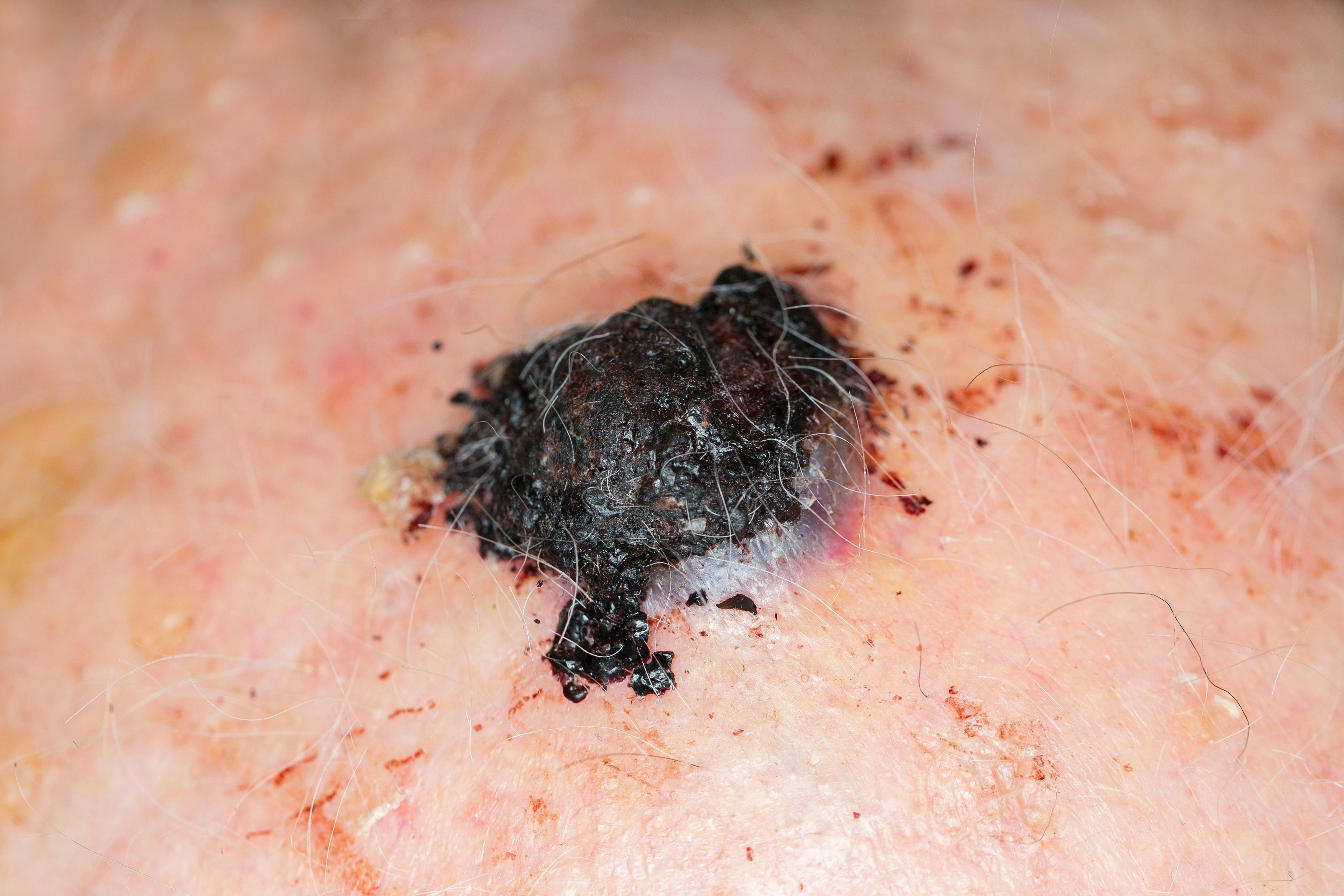Interventions in Minimal Residual Disease Lead to Long-Term Melanoma Control