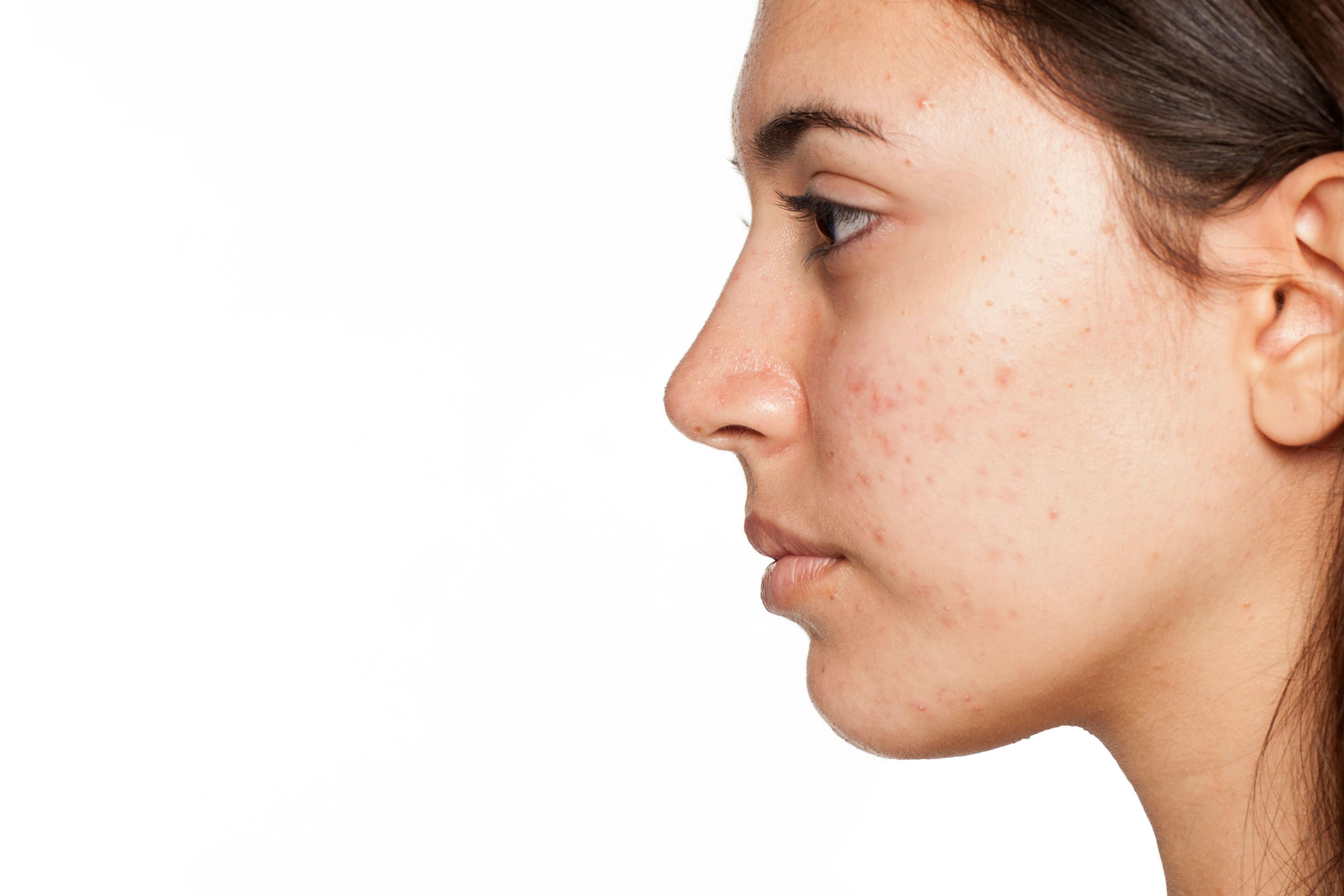 Acne Flares May be Worsened by Climate Change
