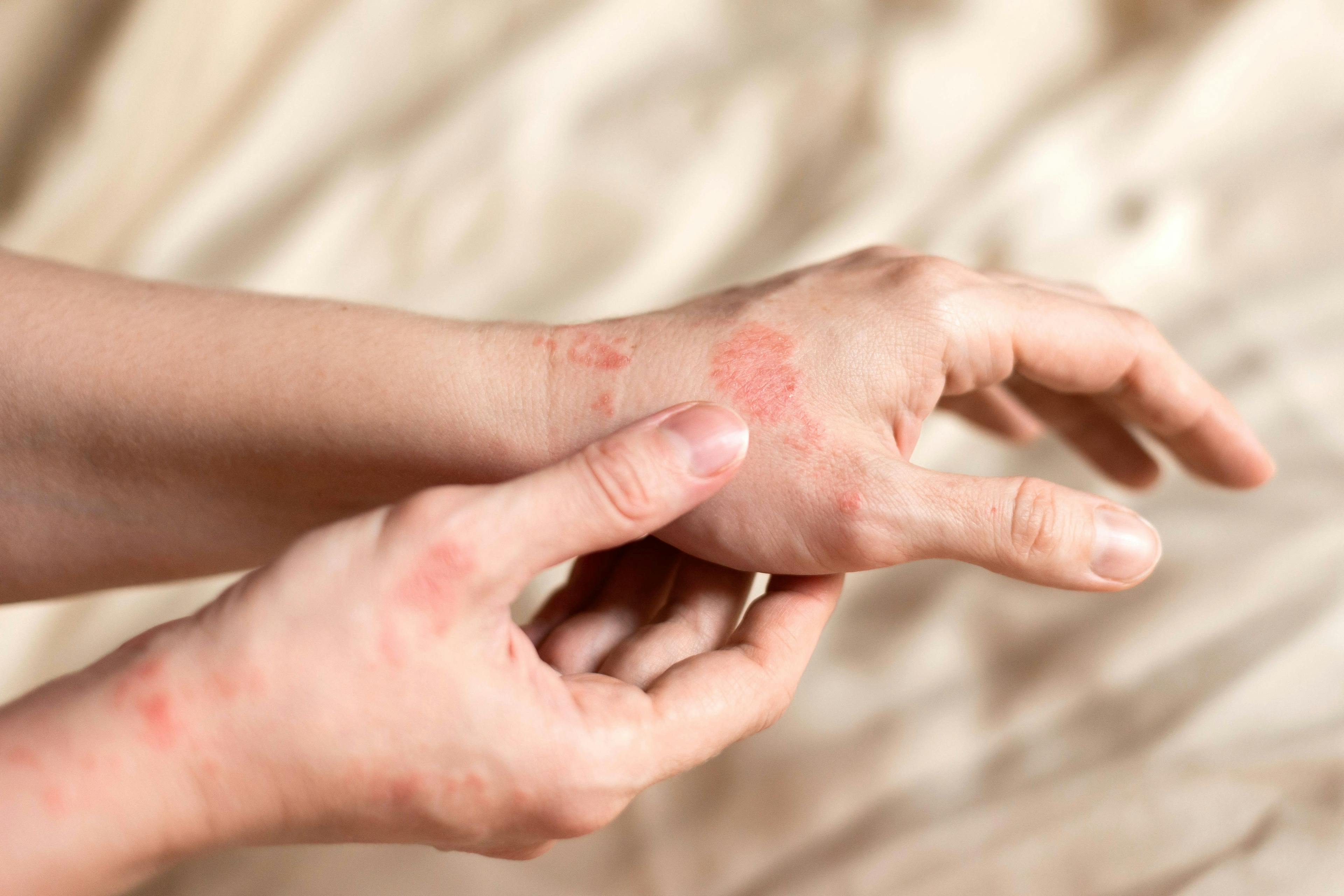 Main Sensitizers, Overlapping Etiologies Identified in Hand Eczema