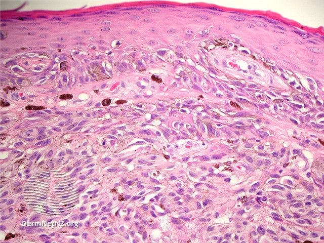 Melanoma pathology: vertical growth phase

Image courtesy of DermNet