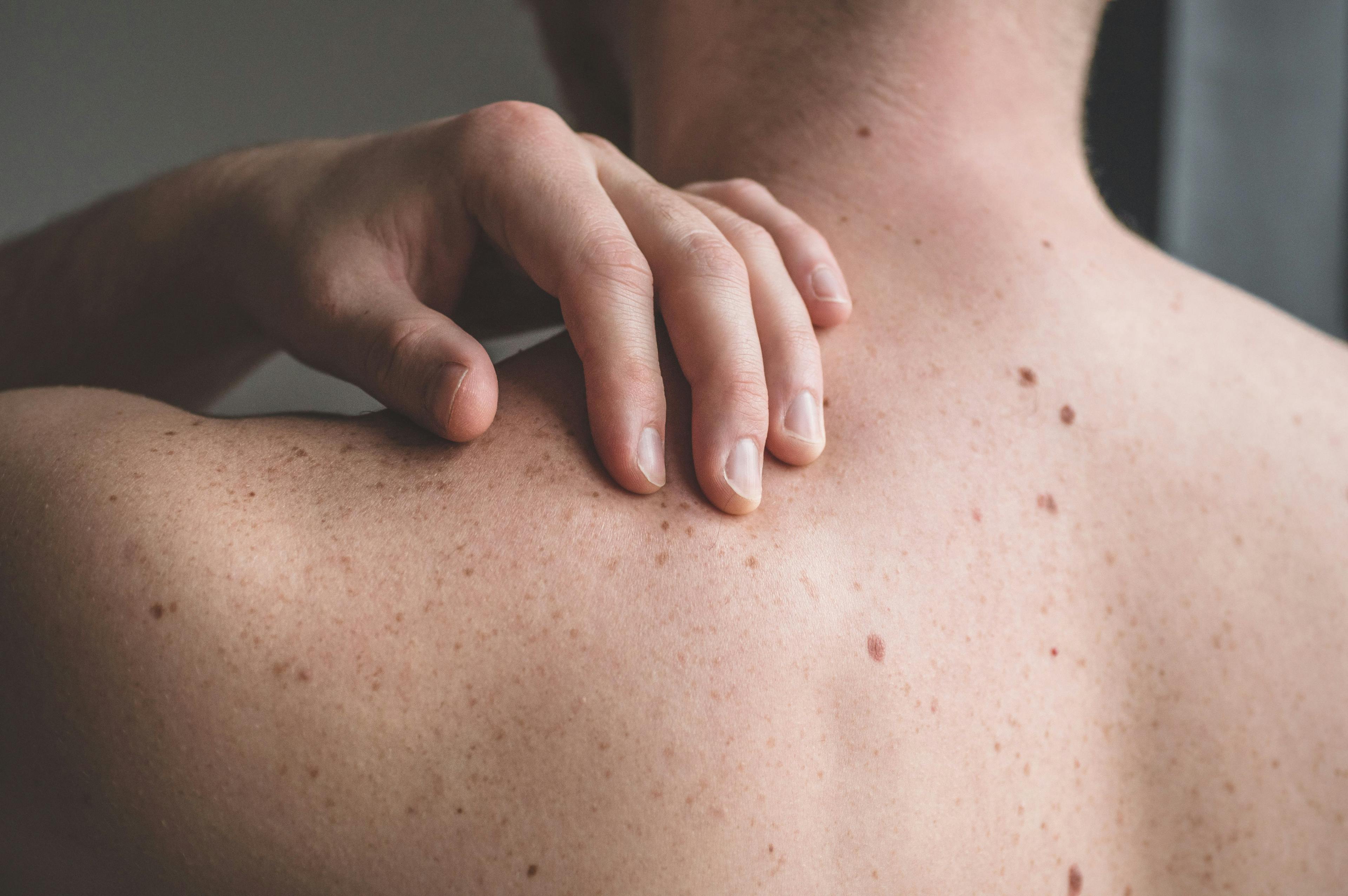 FDA Accepts Priority Review for Melanoma Treatment