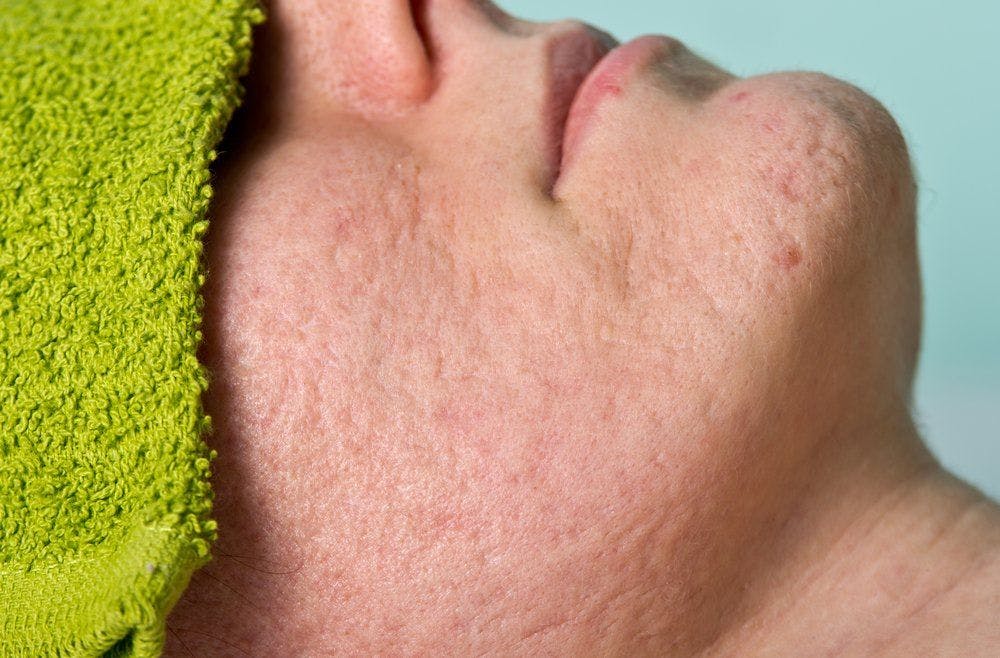 10 Treatments for acne scarring