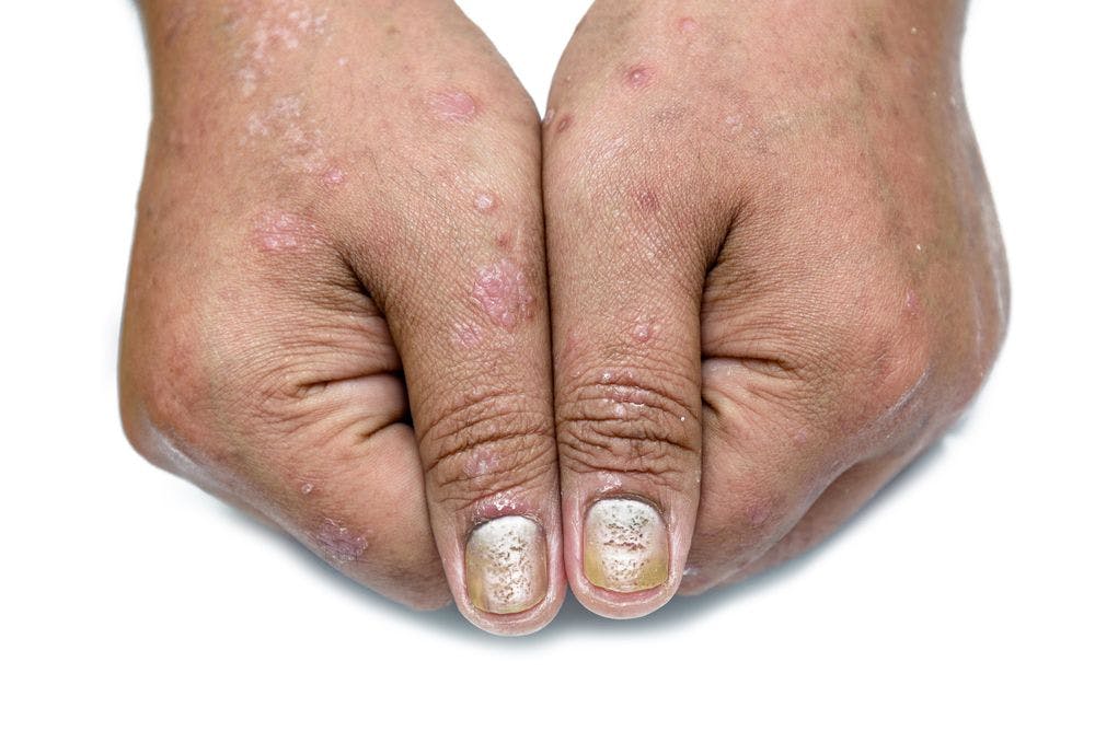 Fingernail Psoriasis 2 (©SweetheartStudioShutterstock.com)