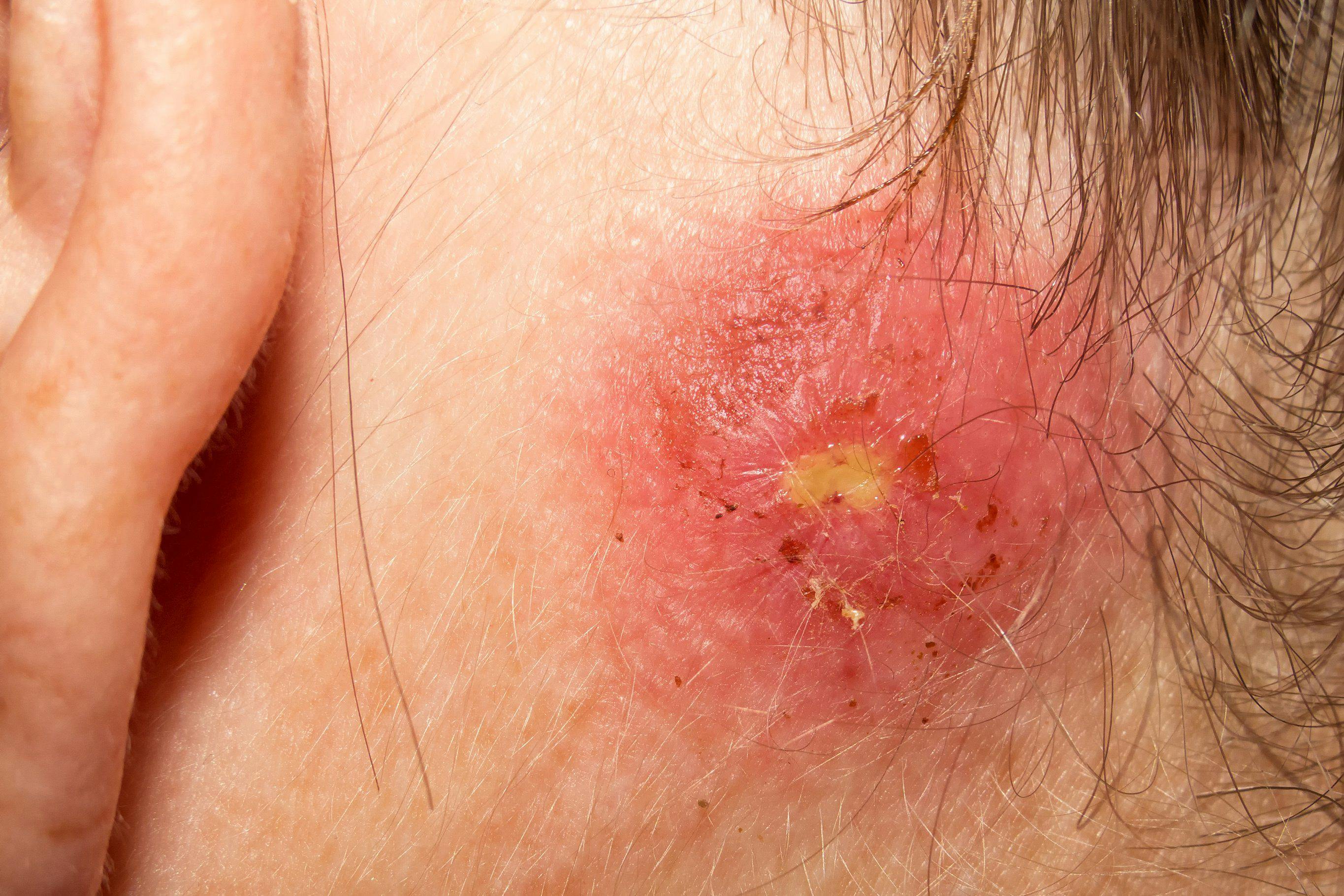 Staphylococcus aureus behind ear Staph infection