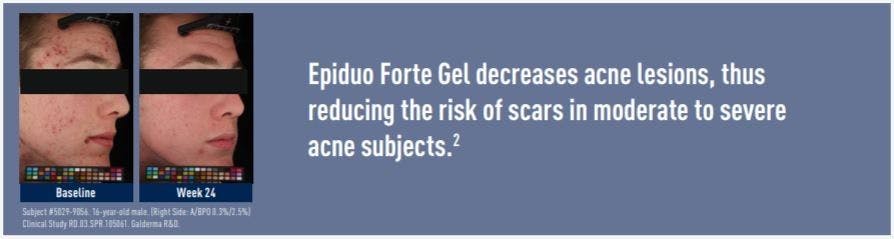 Epiduo Forte gel-clinical image
