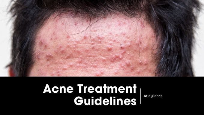 Acne treatment guidelines at a glance