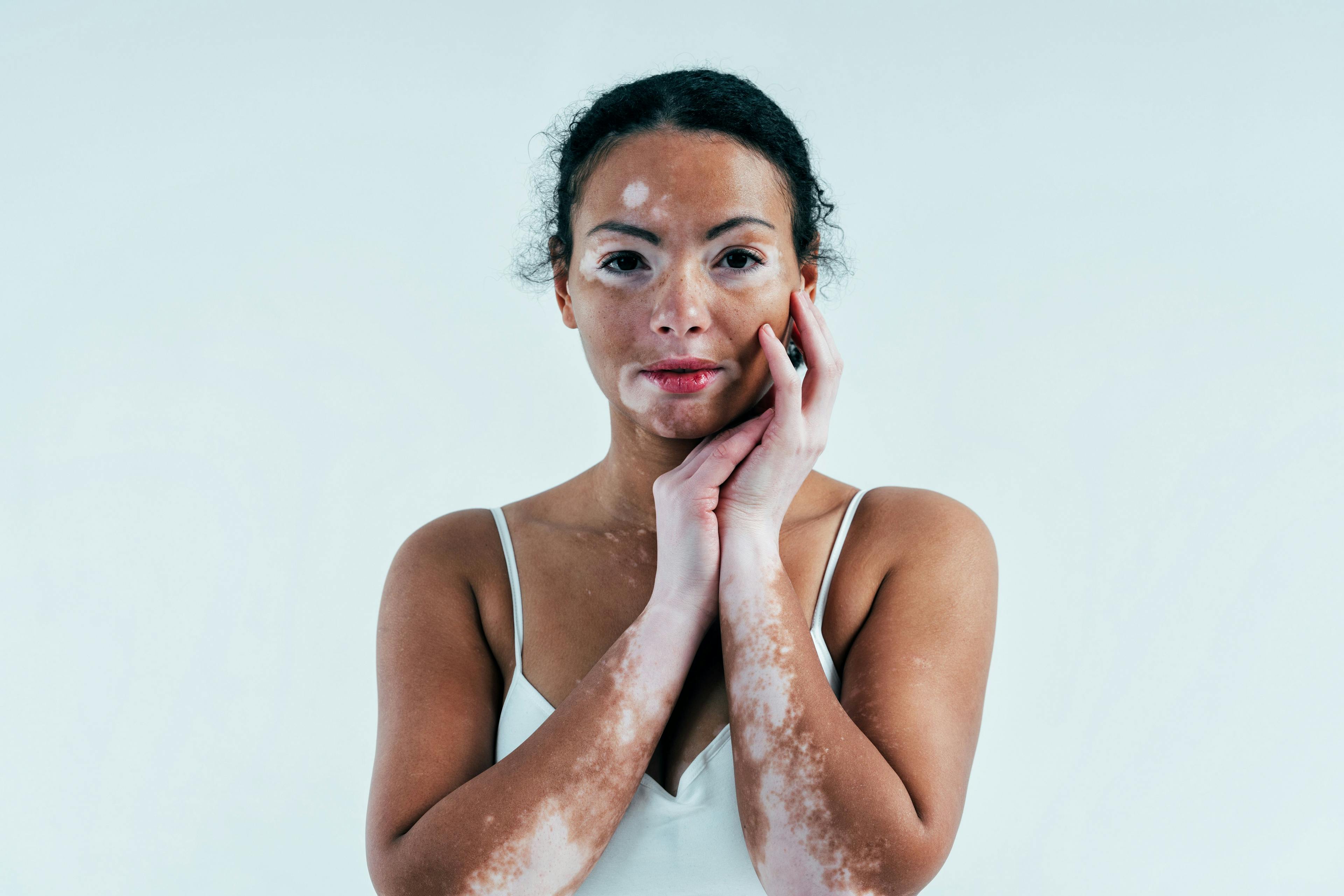 Studies Find High Prevalence of Suicidal Ideation in Patients with Vitiligo