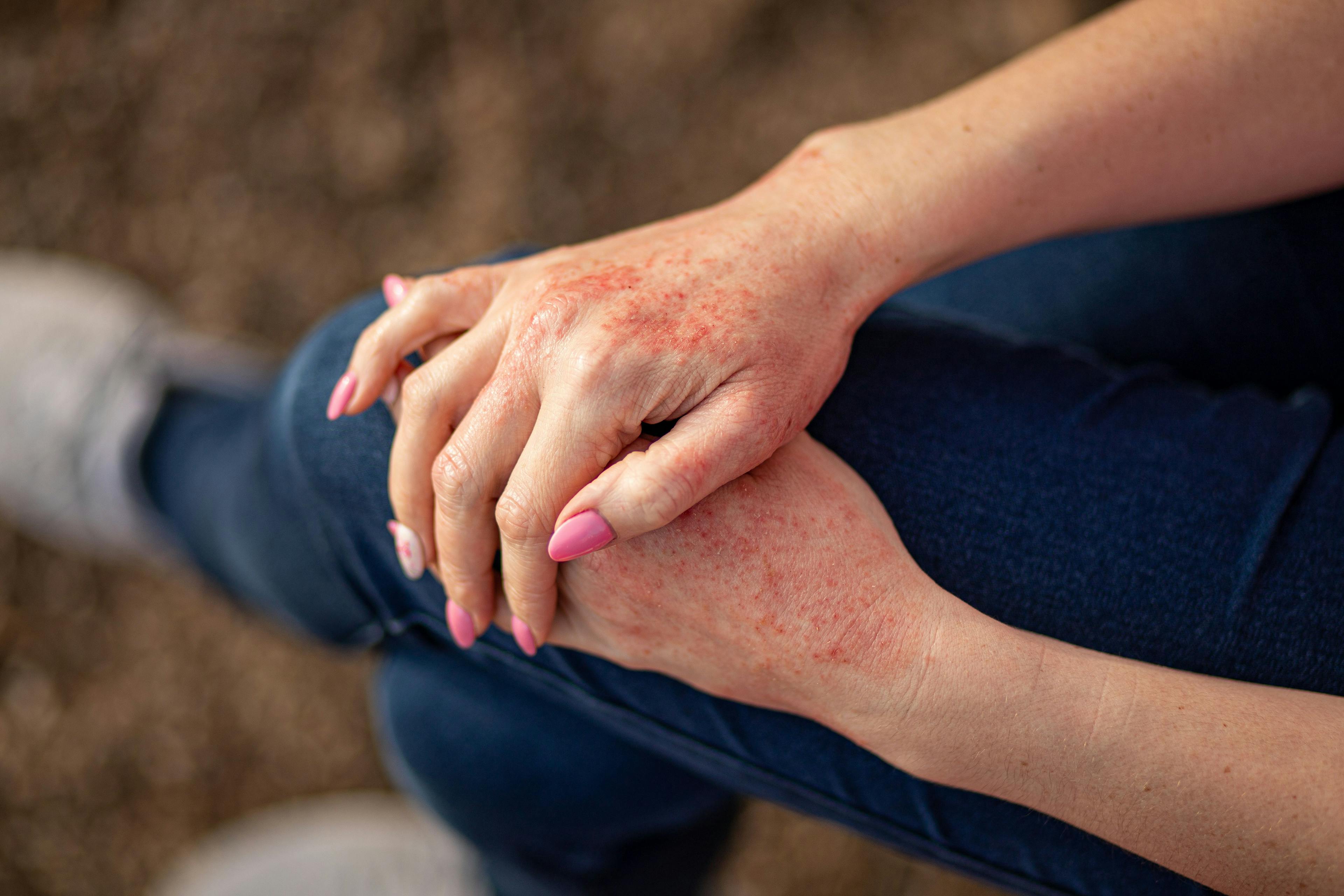Close up of atopic dermatitis on the hands of a woman