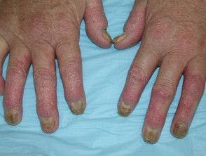 Comparison of Psoriatic Arthritis Therapies Finds Bimekizumab More Effective Than Guselkumab