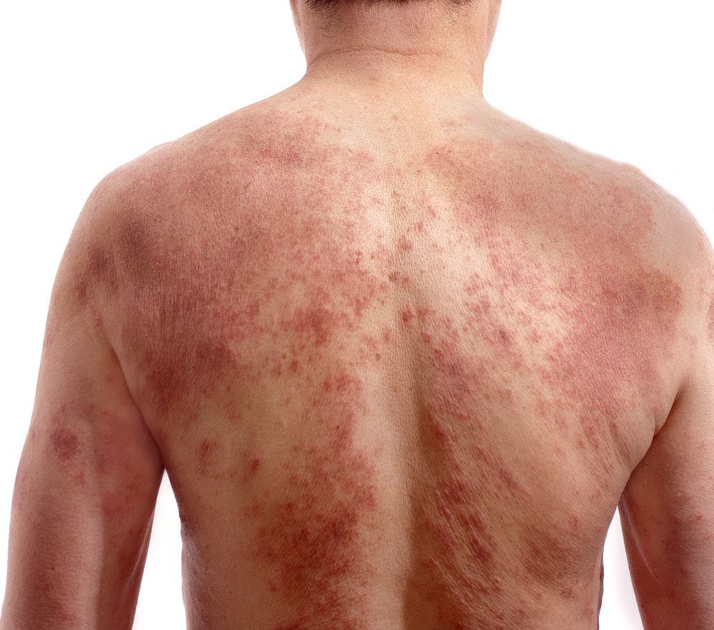 Psoriasis biosimilar approved by FDA