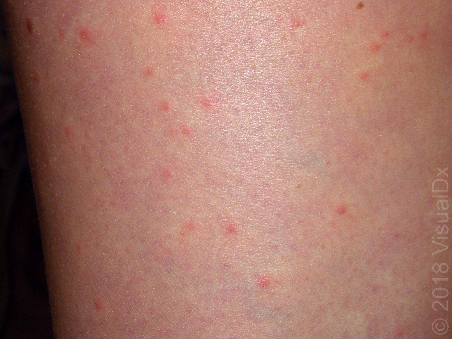 Image IQ: End of summer trip and a widespread rash