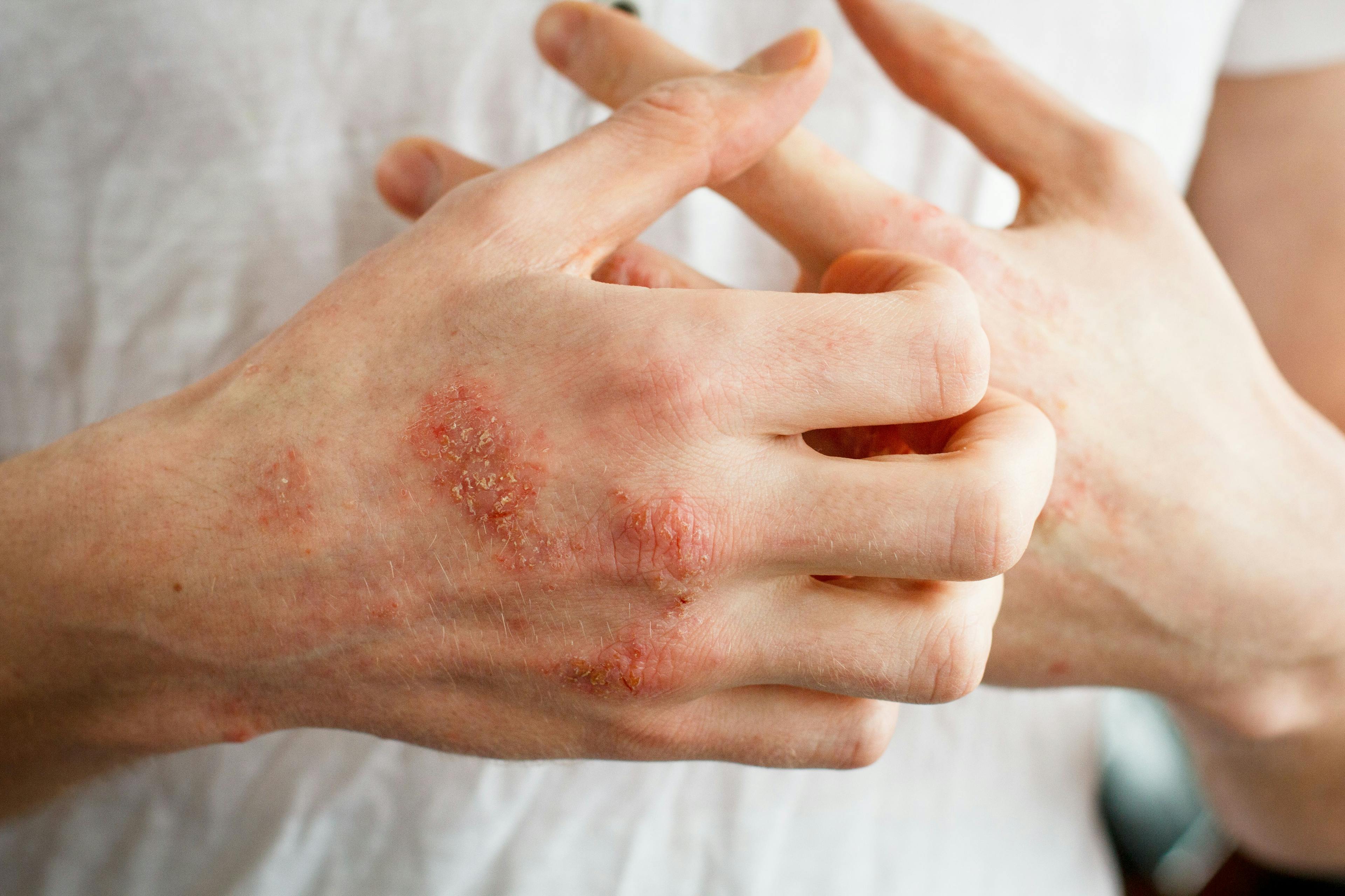 Patients With Moderate-to-Severe Atopic Dermatitis Experience Impaired QOL, Feel Disease Burden