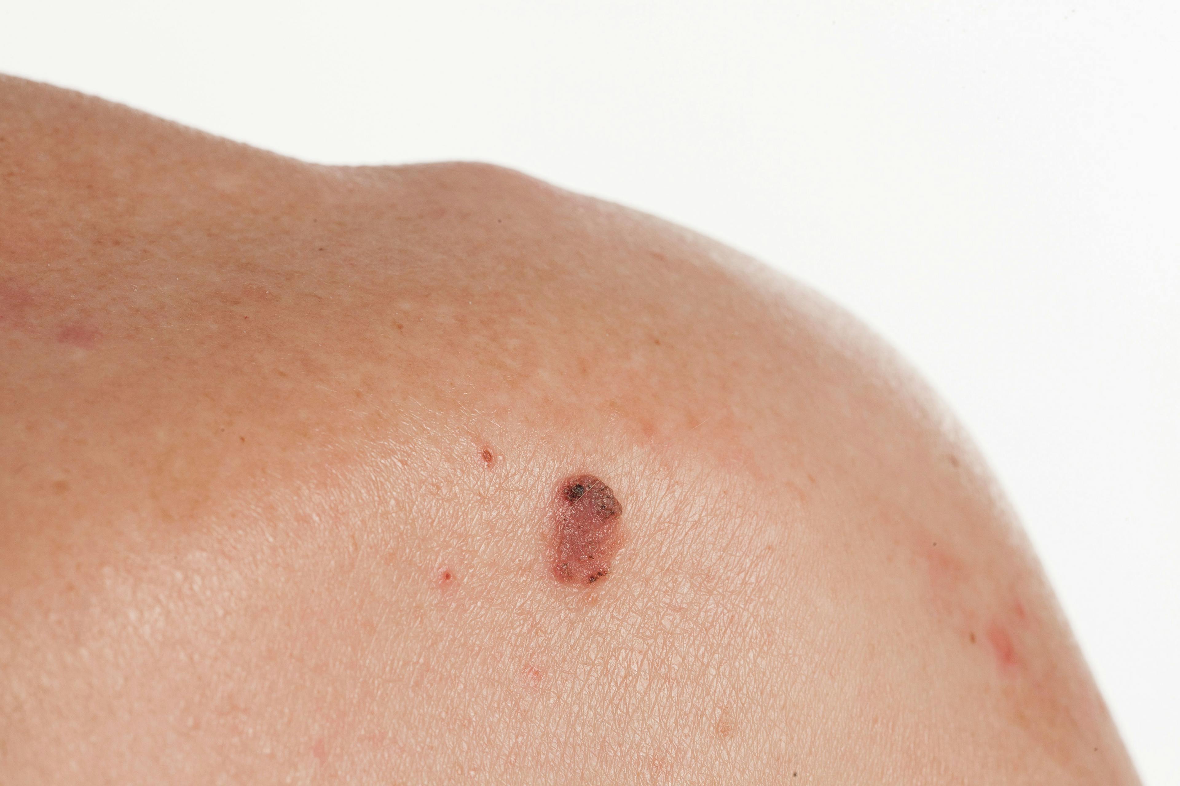Nonsurgical Treatment for Nonmelanoma Skin Cancer Exhibits 99% Cure Rate