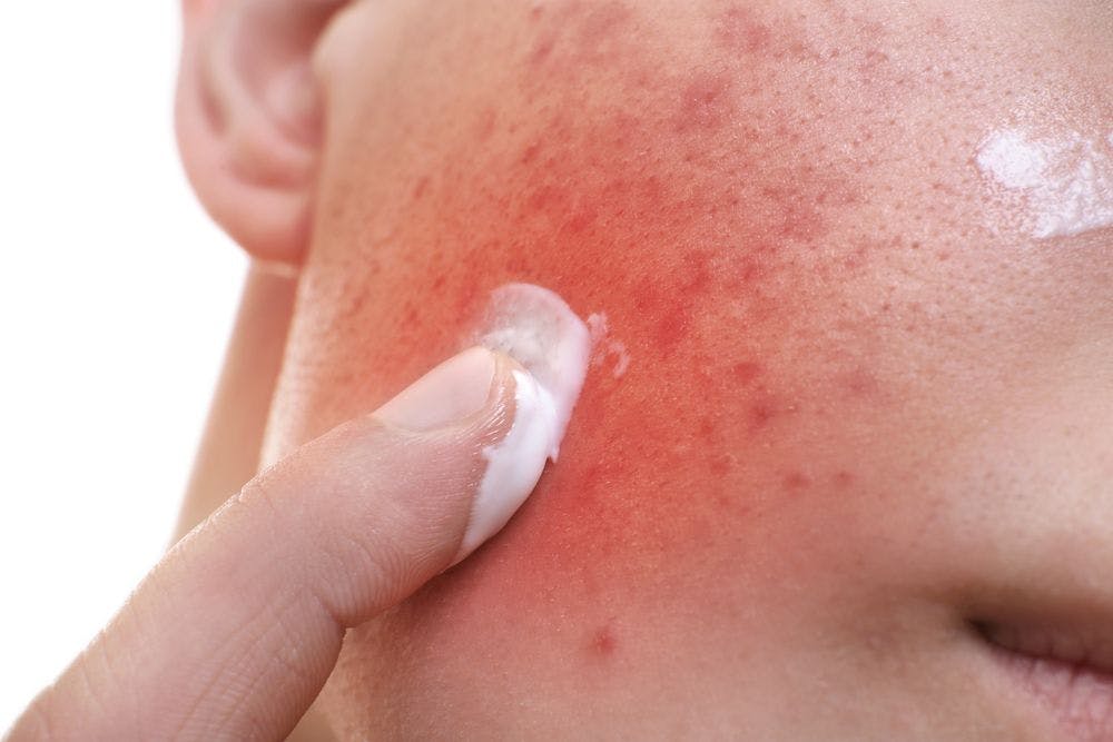 Person putting white lotion on inflamed acne on face