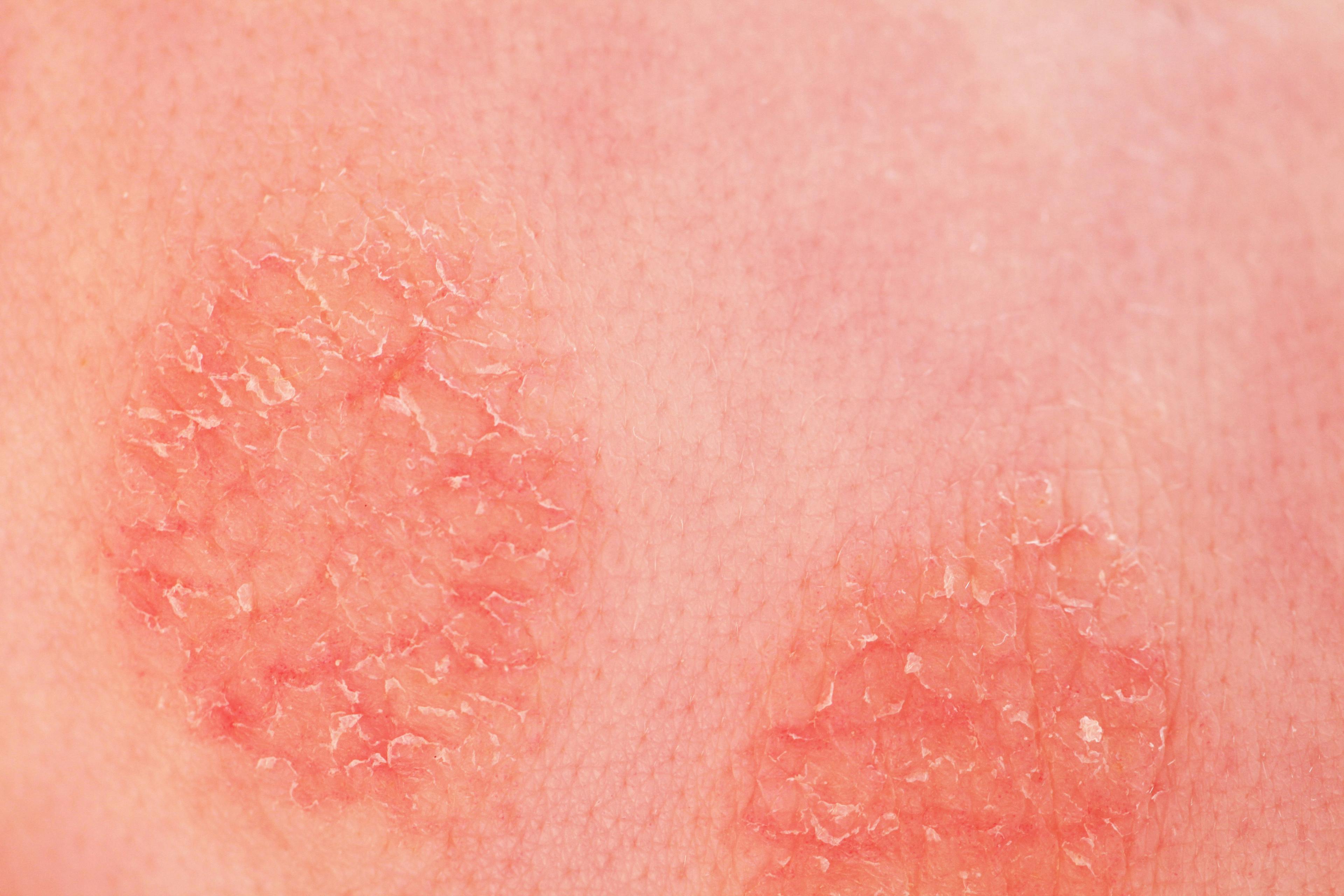 A Dermatology Rash Diagnostic for the Allergist