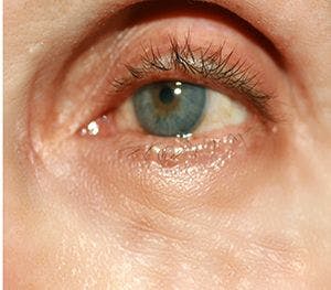 eyelid rejuvenation, periorbital wrinkle, tear trough, 