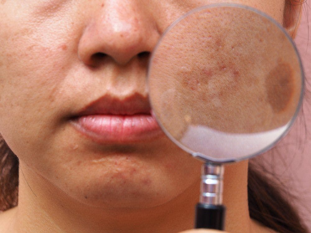discolored patch of skin on cheek