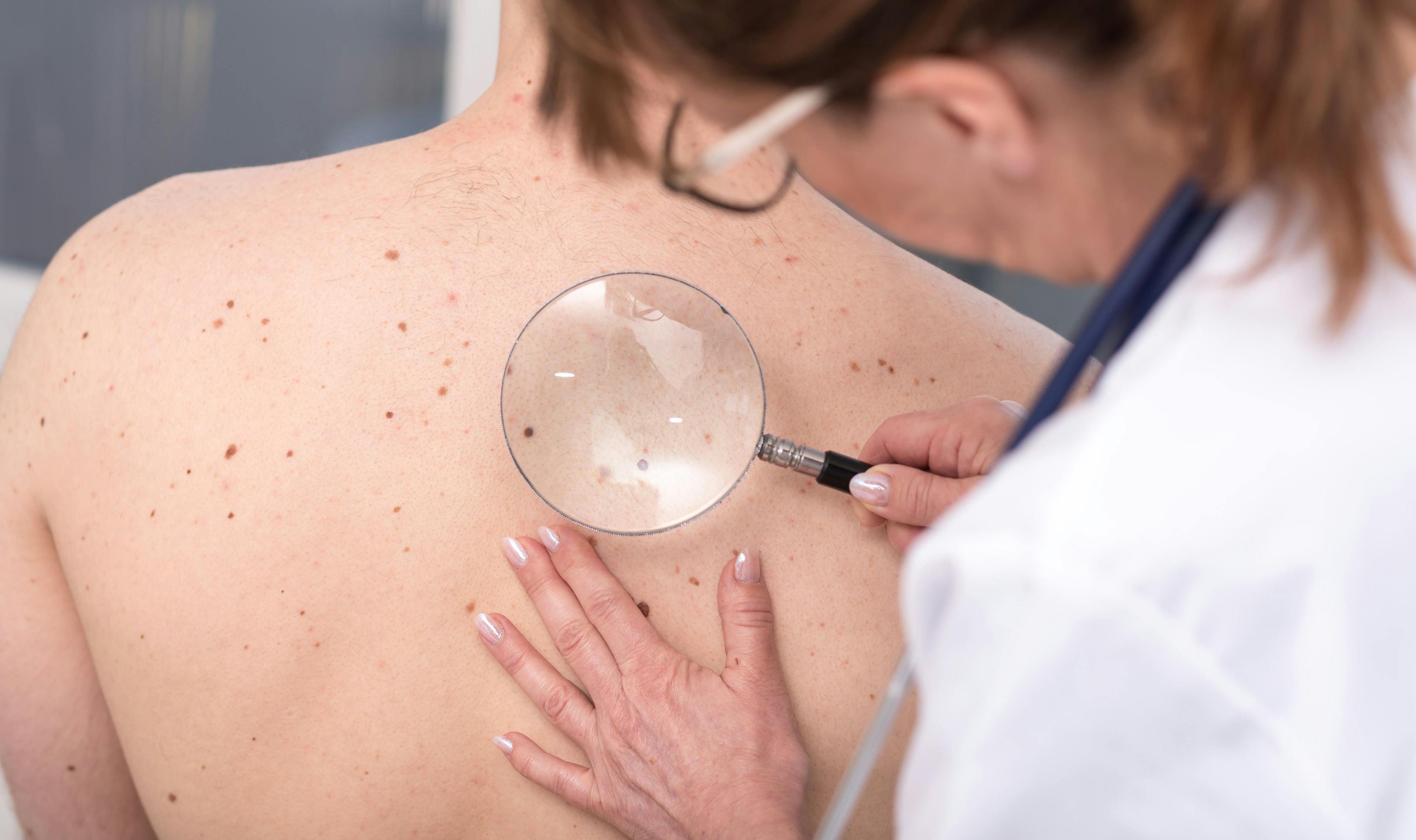 What’s New in Skin Cancer 