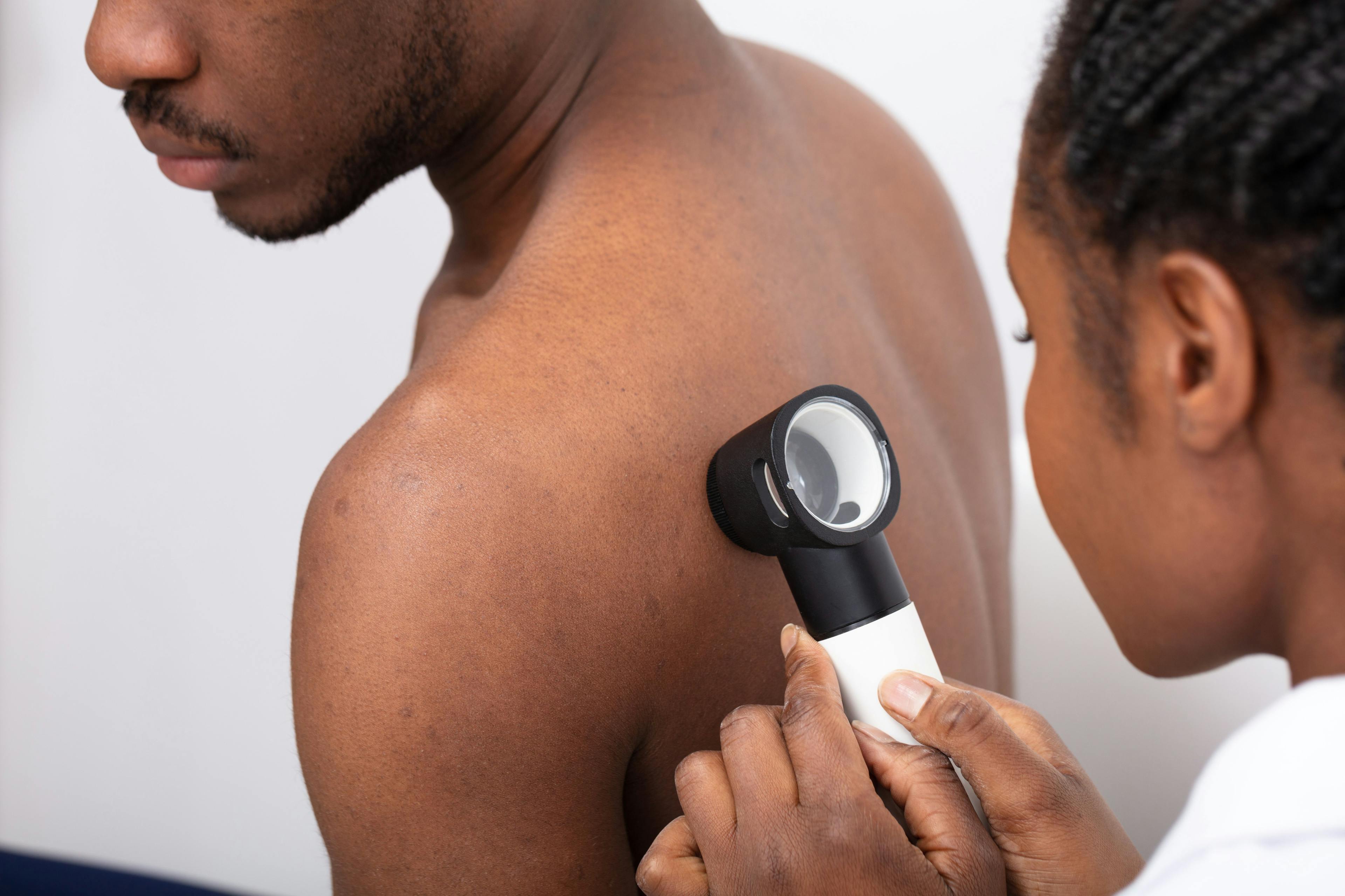 black patient receiving skin exam