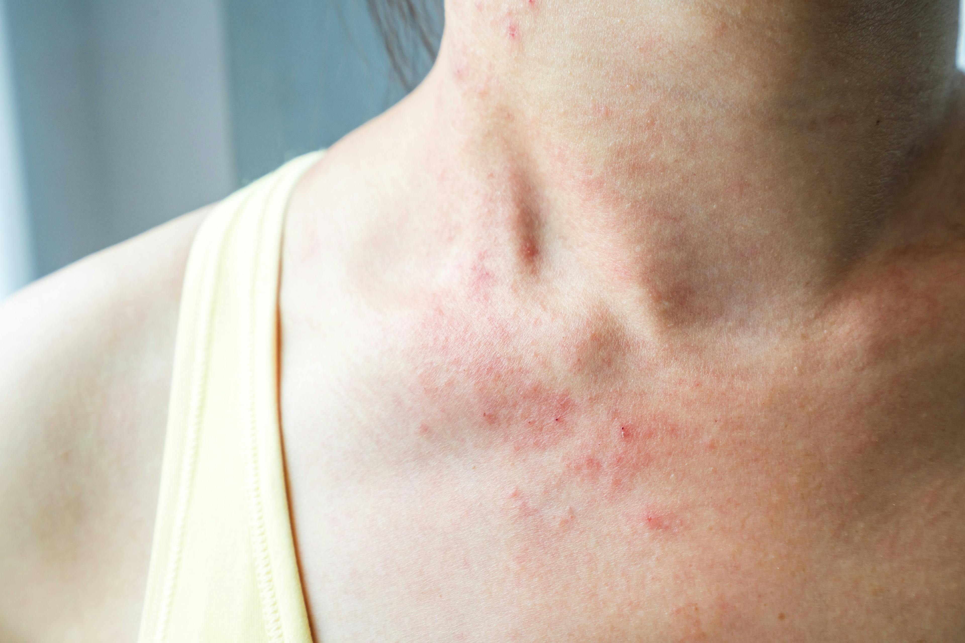 An In-depth Look into Regional Dermatitis and Rash 