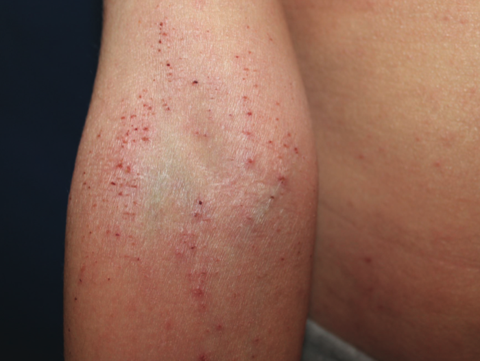 Excoriated erythematous papules on the antecubital area of a 10-year-old boy with severe atopic dermatitis. Photo courtesy of Amy Paller, MD.