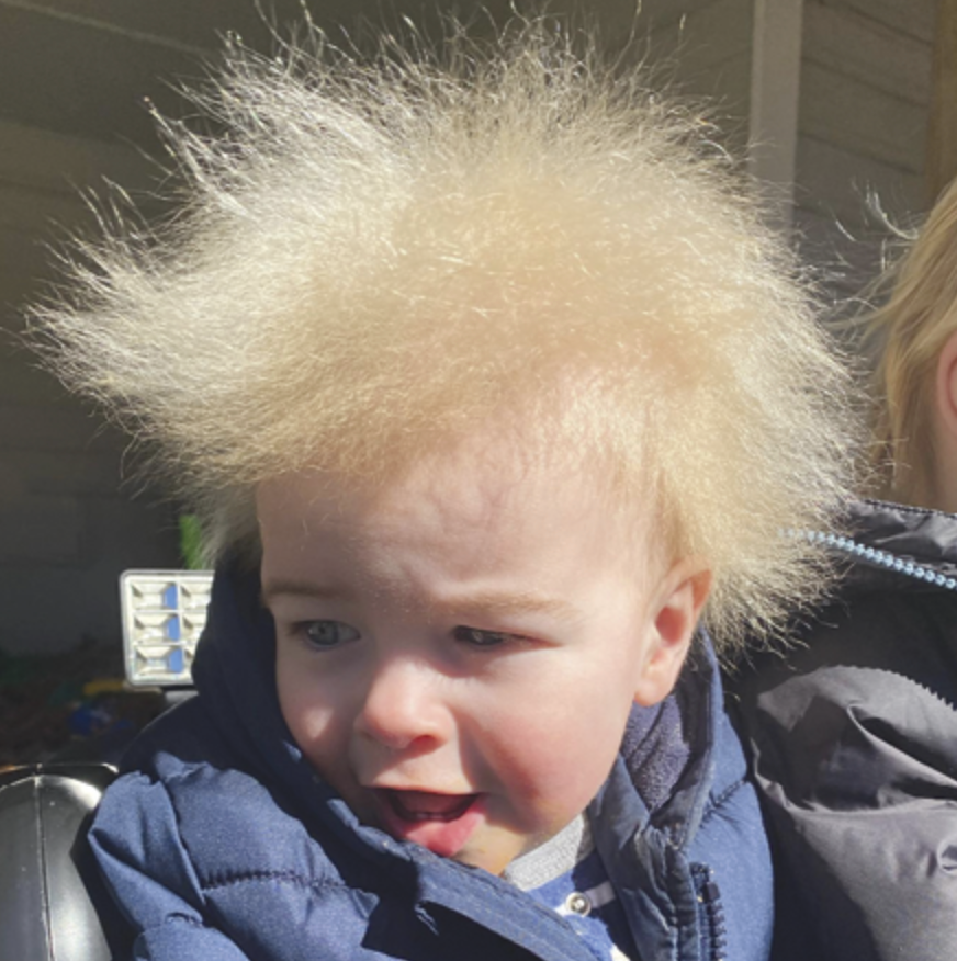  Uncombable Hair Syndrome: How to Identify and Help Children With this Rare Disorder 