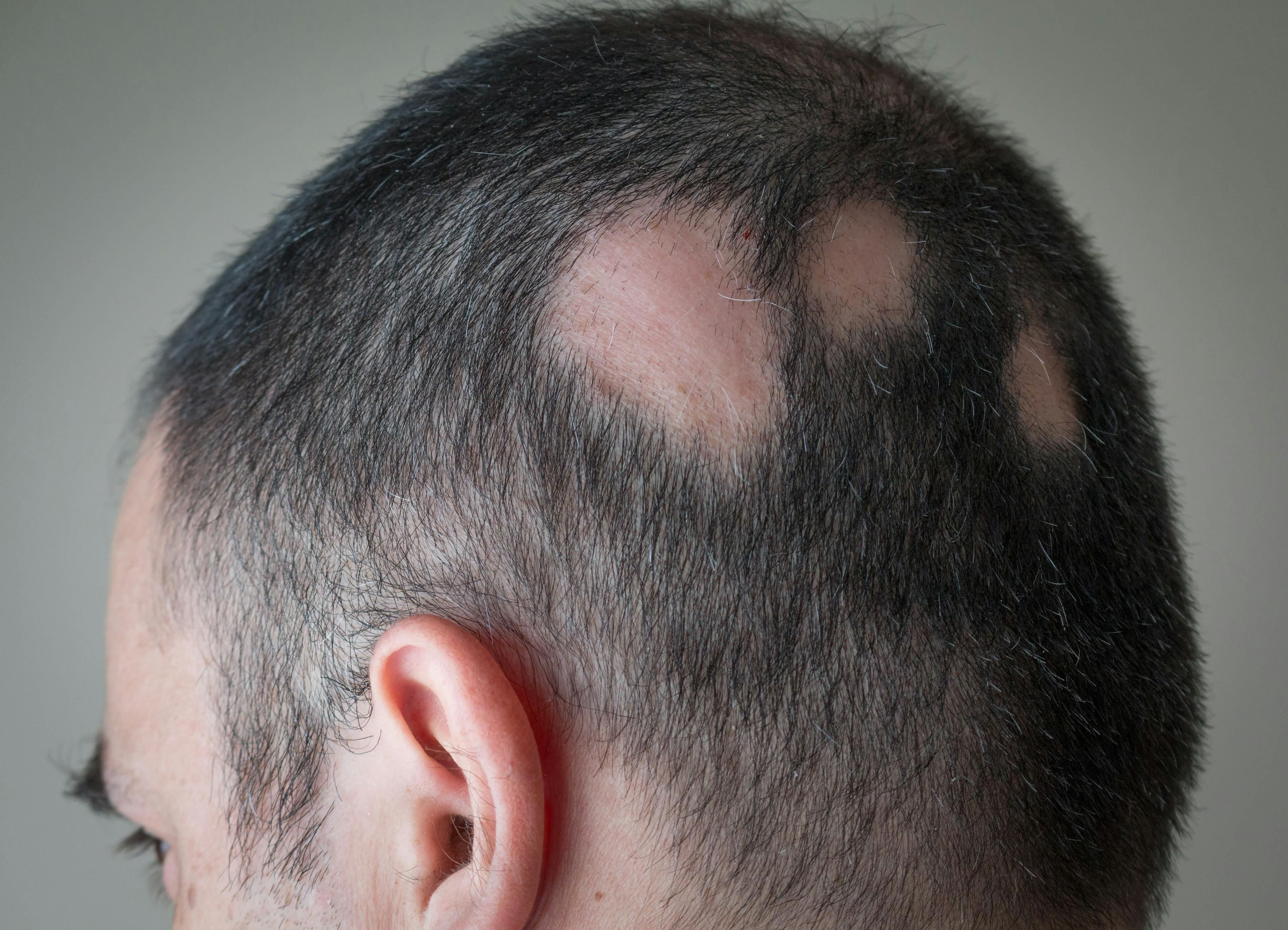 New Study Shows Prevalence of Alopecia Areata in People of Color