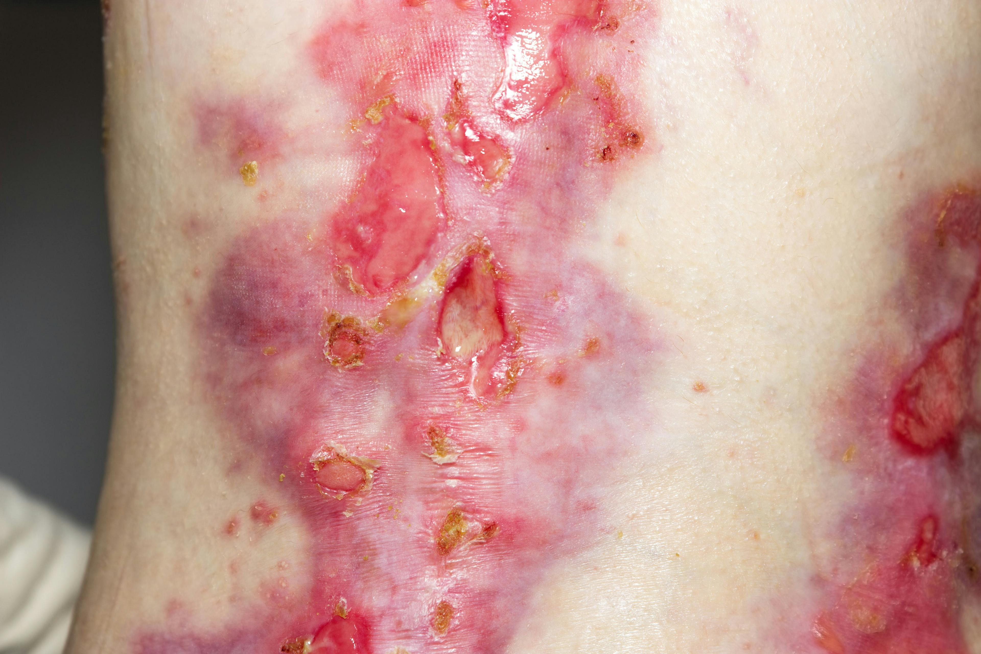 Phase 3 Results of Epidermolysis Bullosa Trial Published in British Journal of Dermatology 