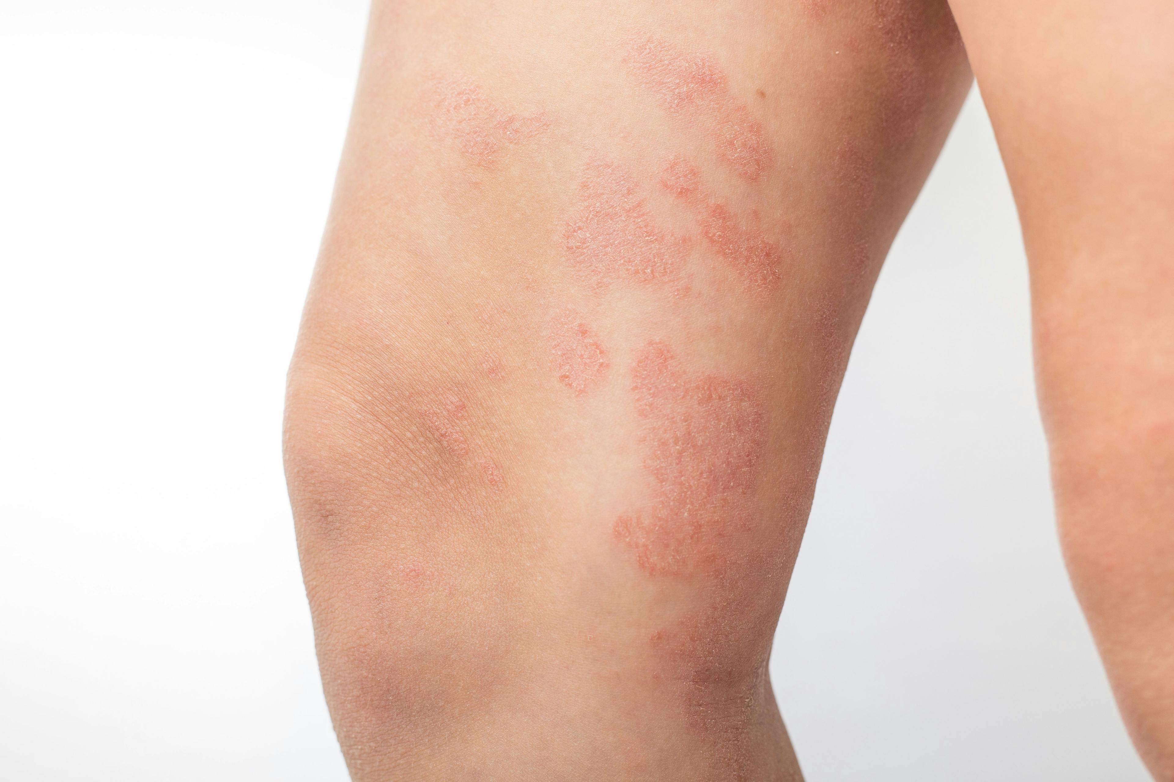Dupilumab With Topical Corticosteroids Alleviates Clinical Symptoms of Pediatric Atopic Dermatitis