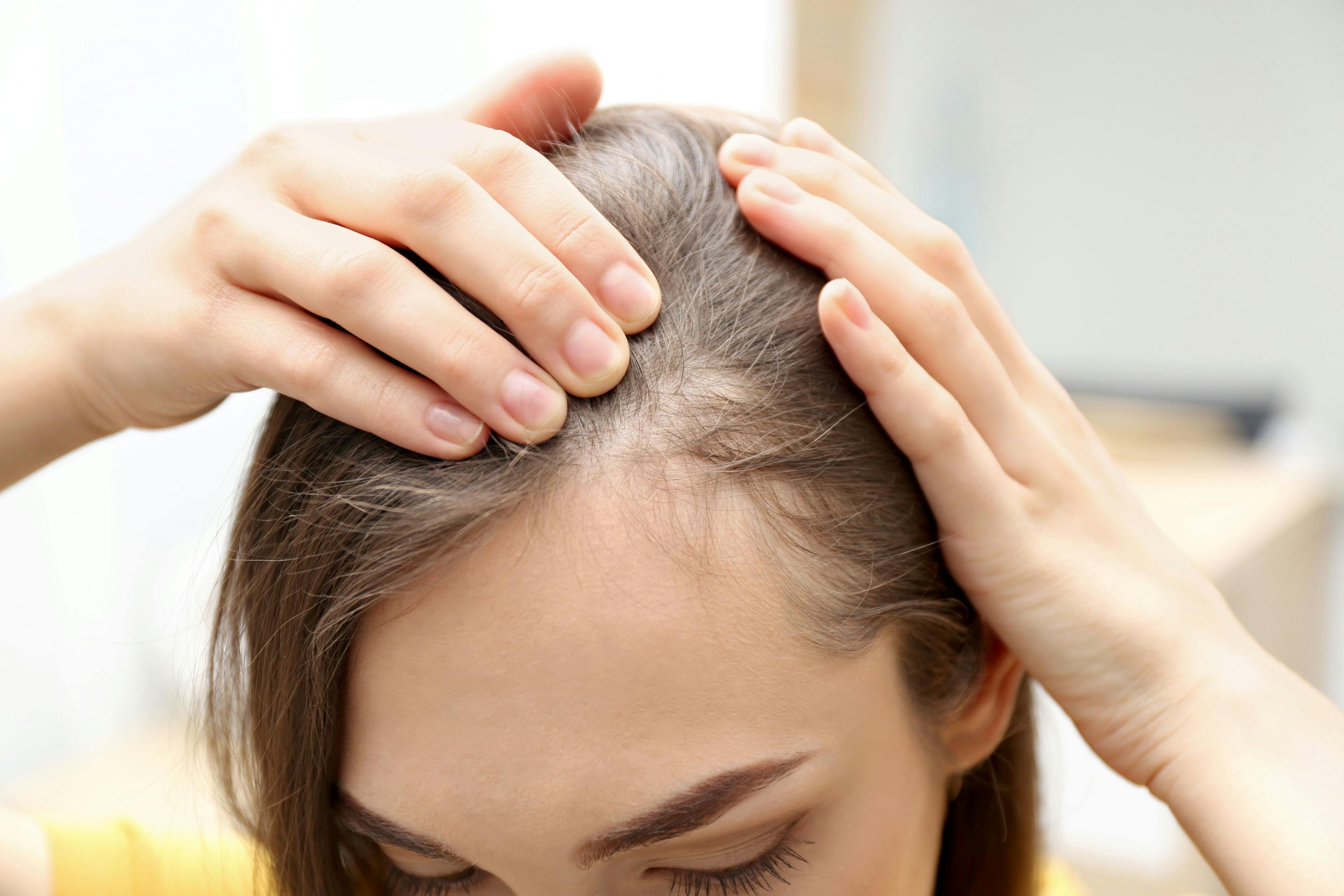 Minoxidil-Spironolactone Therapy Effective in Treating Hair Loss in Women