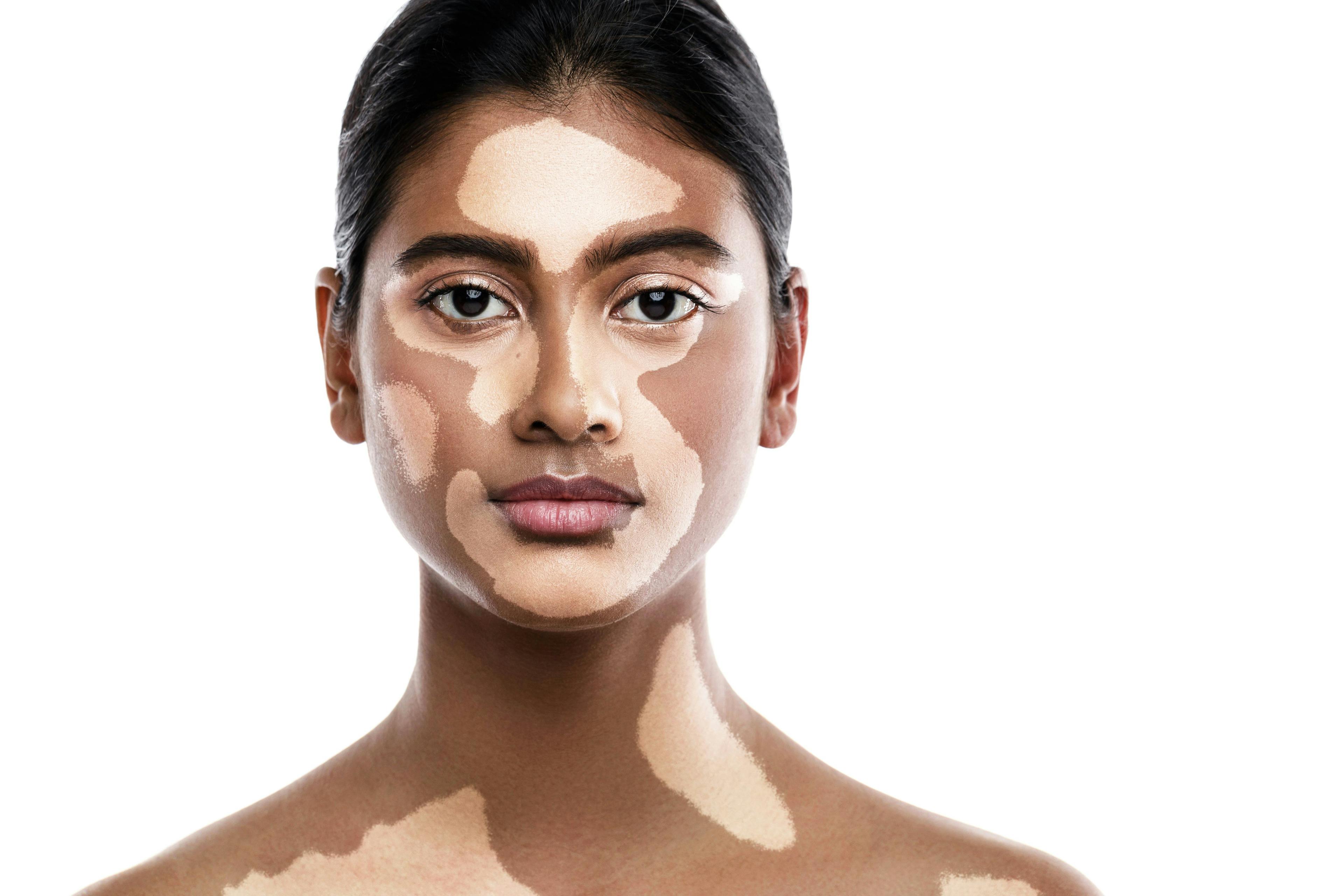 25.1% of Patients Cited “Less Noticeable” Vitiligo in Recent Study