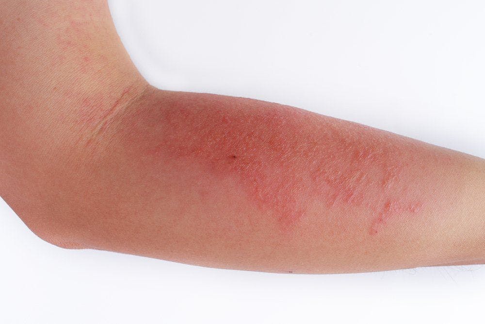 Red inflamed skin on arm