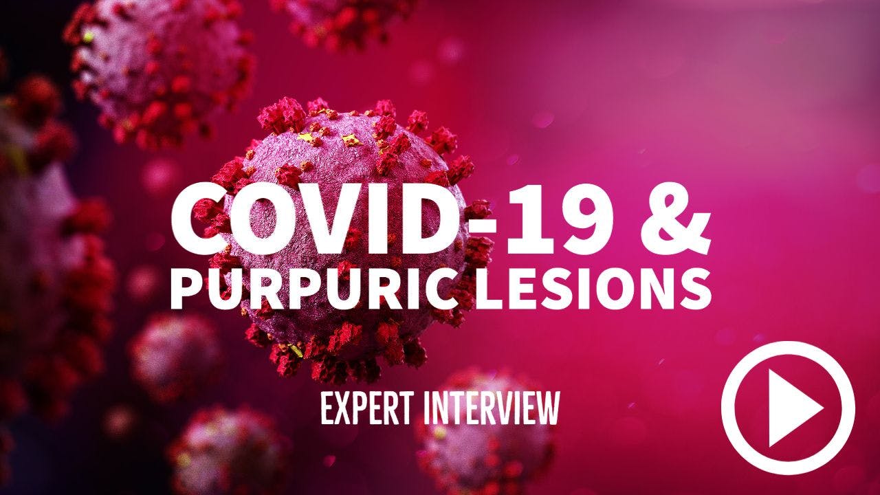 Illustration of COVID-19 with writing "COVID-19 & purpuric lesions - Expert Interview"
