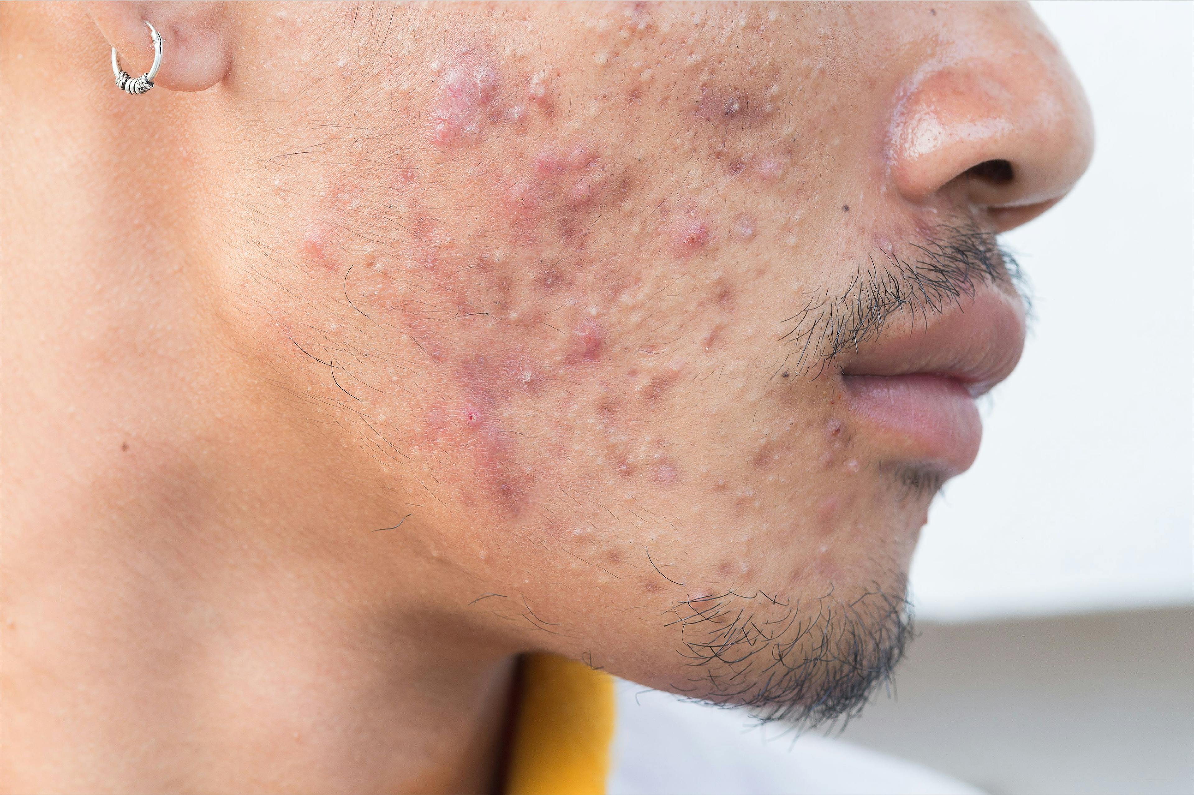 Dermatologists Post Less Than 4% of Top Acne Content on Instagram