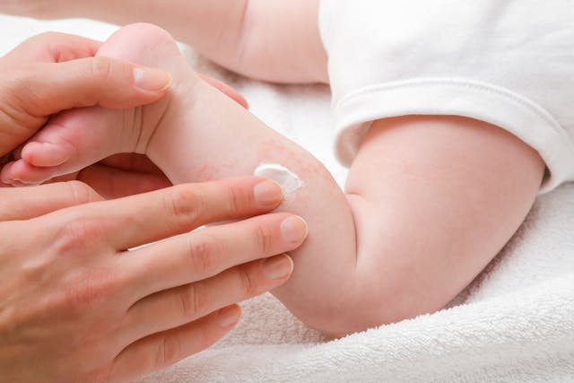 Non-Invasive Test That May Help Predict Eczema in Babies
