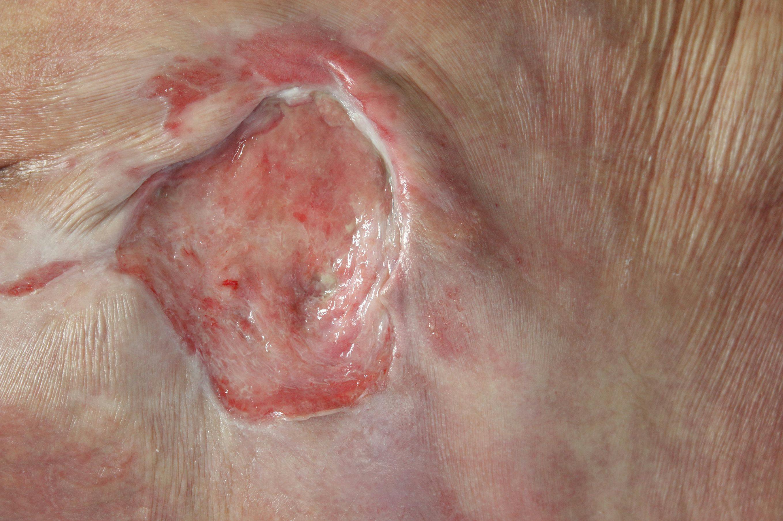 Patients With Pressure Ulcers Face Compromised Skin Parameters