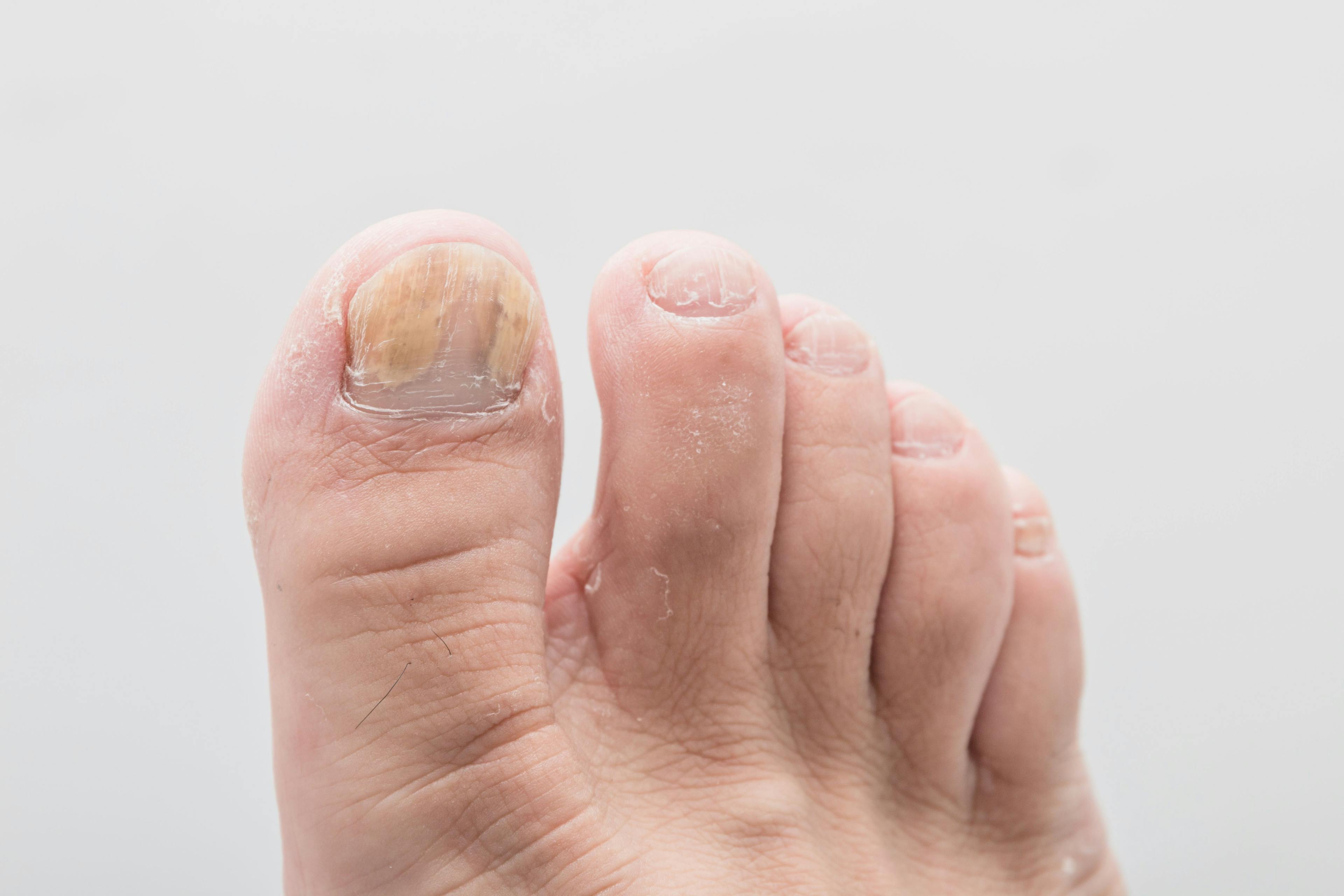 Close-up foot of nail fungus - image credit: daizuoxin © Adobestock