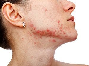 Study finds HS associated with acne conglobata