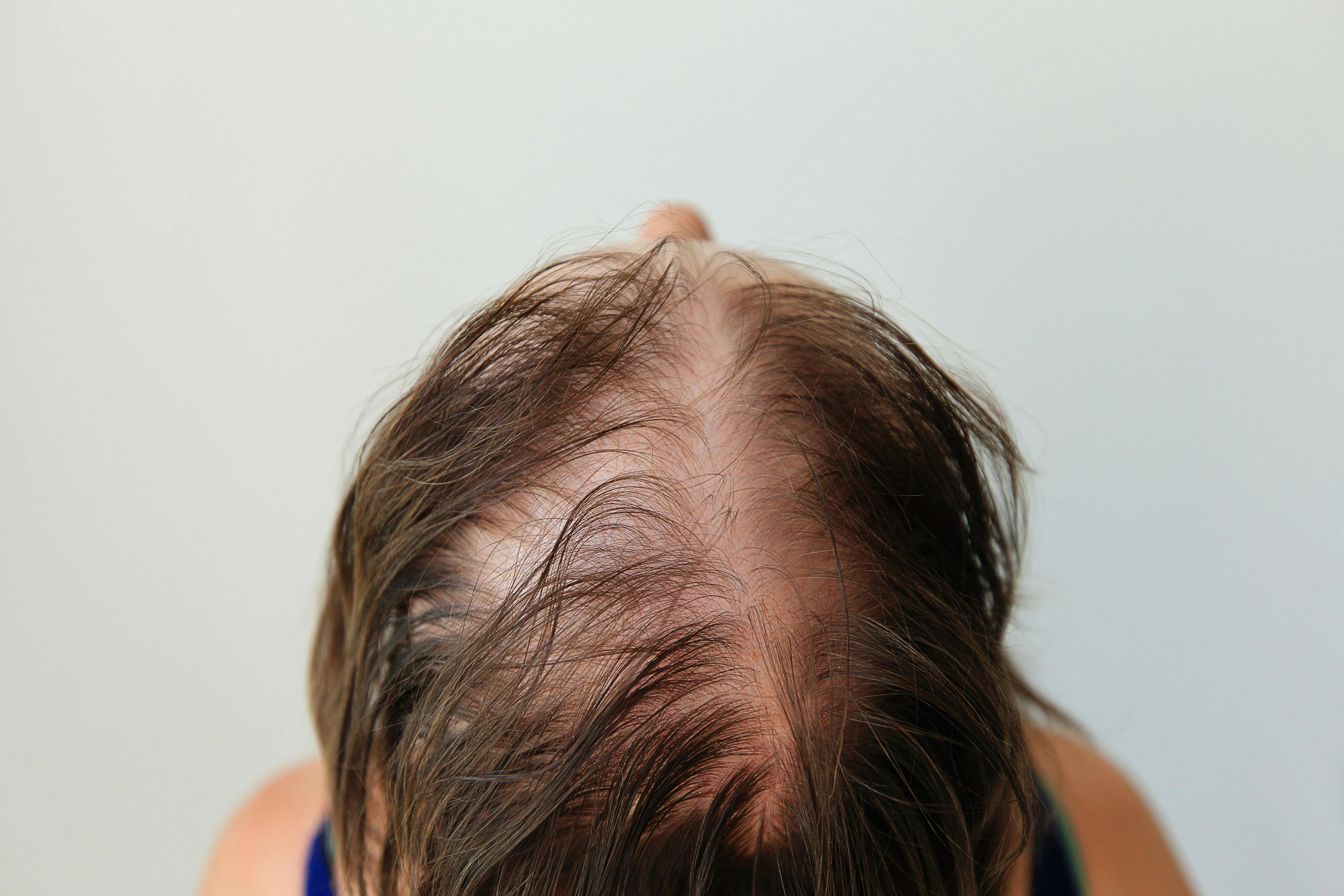 First Patient Dosed in Phase 2 Trial of Bempikibart for Alopecia Areata