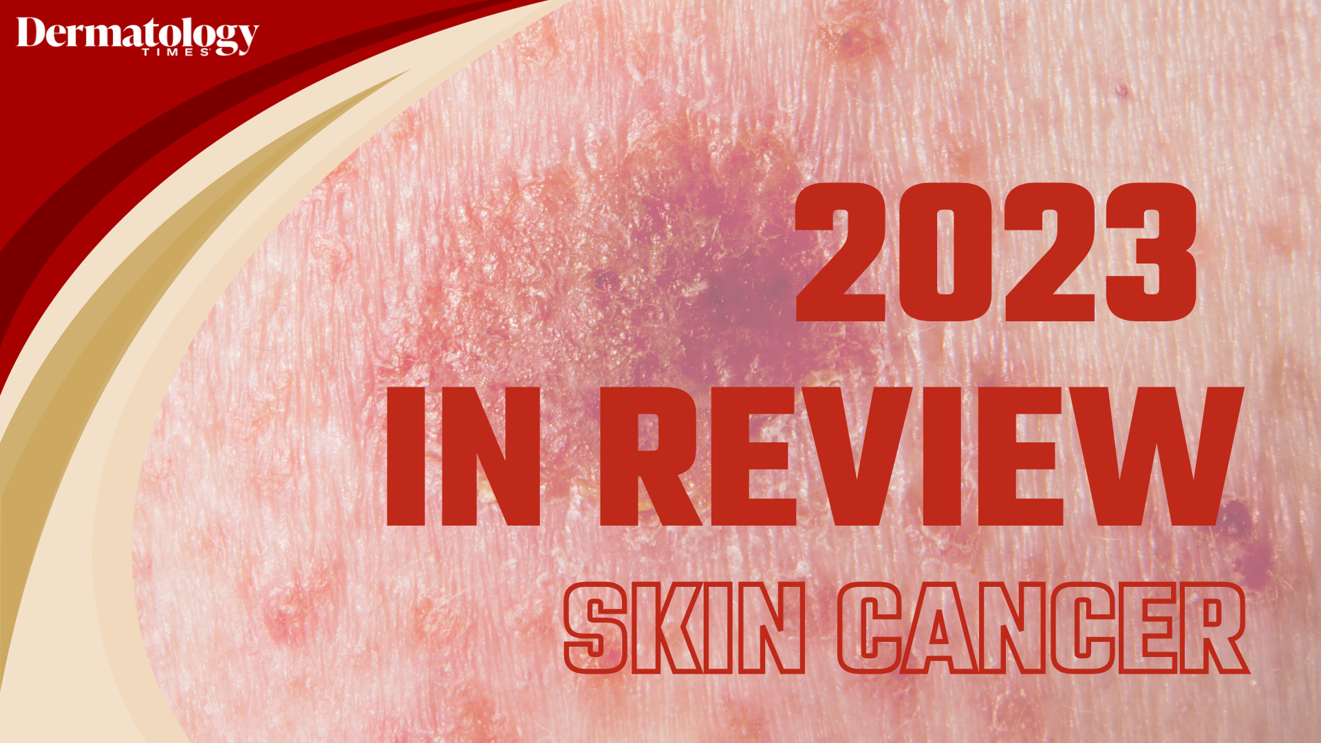 Dermatology Times 2023 In Review: Skin Cancer
