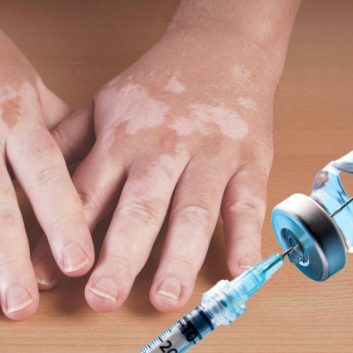 Case Study: Vitiligo Onset Following COVID-19 Vaccination