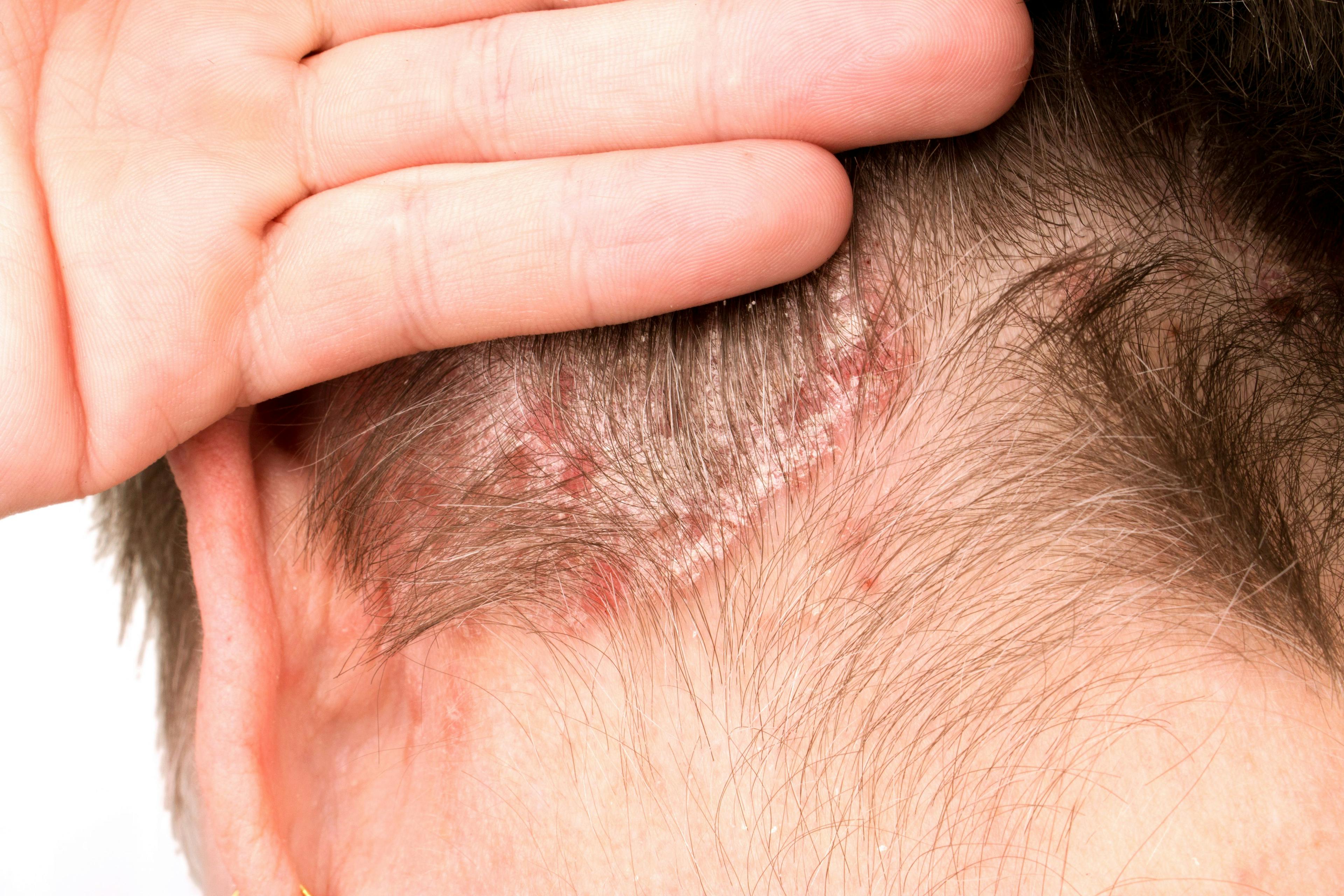 New Study Data of Roflumilast Foam for Scalp and Body Psoriasis 